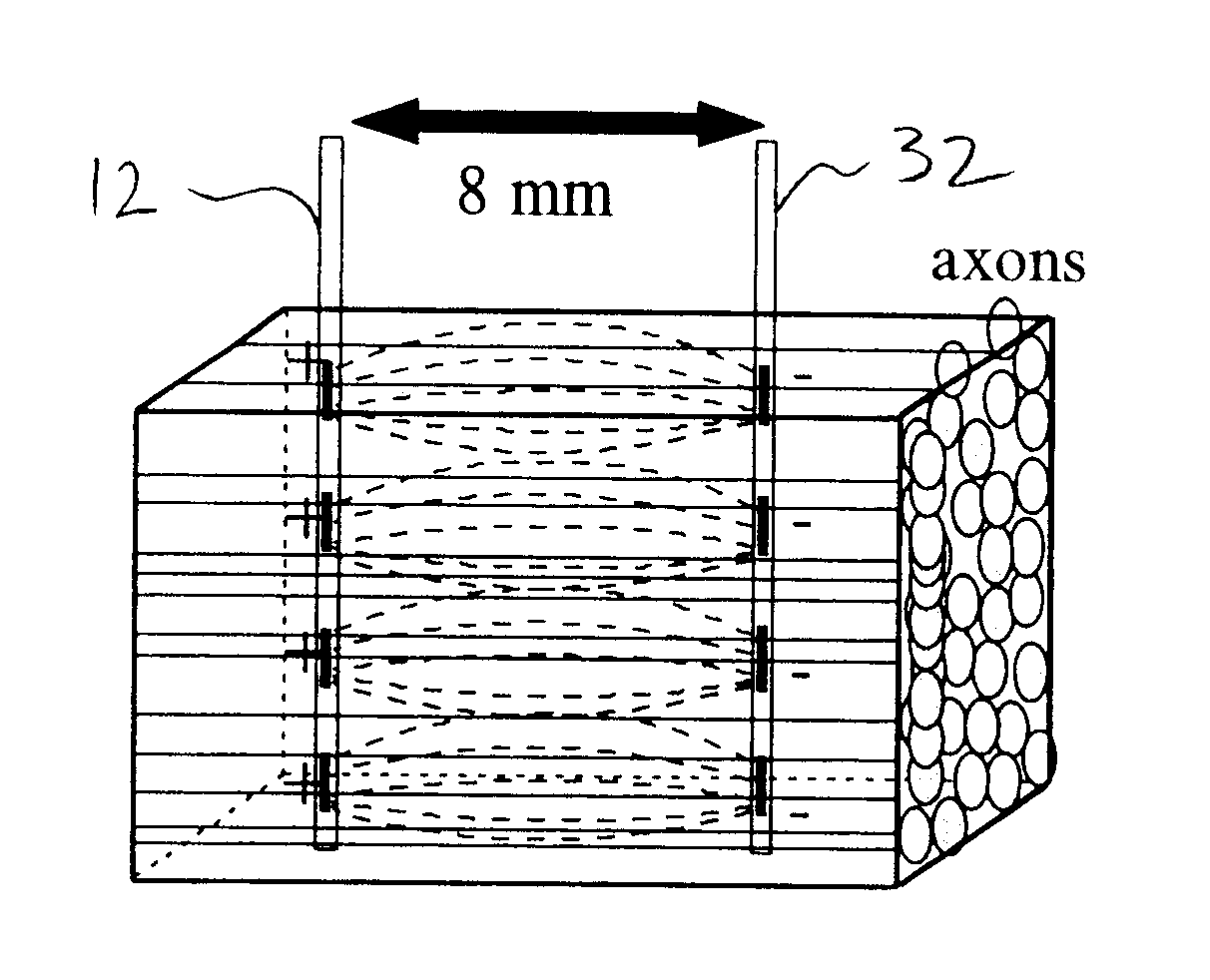 Method for treating obsessive-compulsive disorder with electrical stimulation of the brain internal capsule