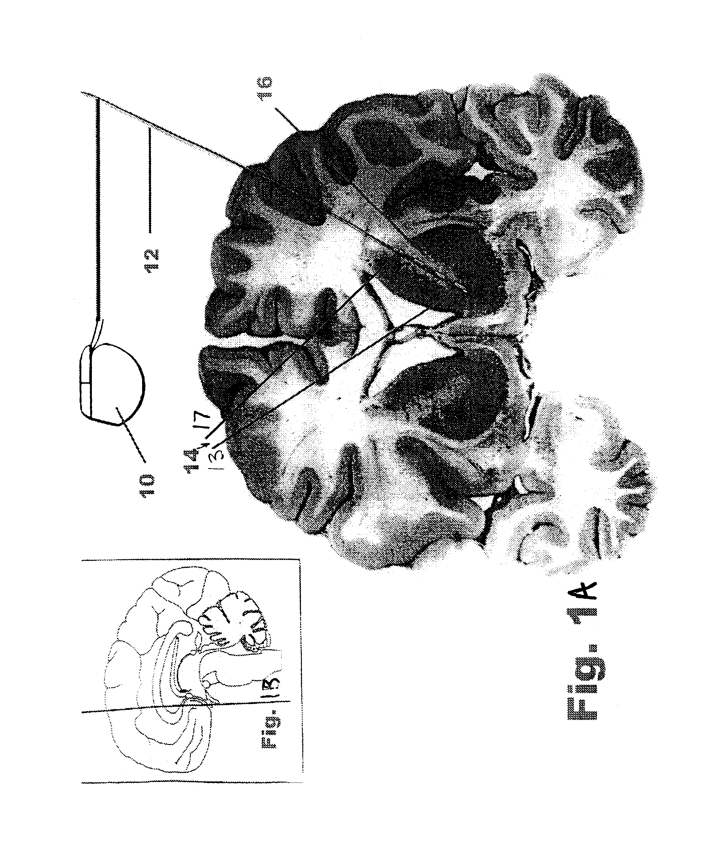 Method for treating obsessive-compulsive disorder with electrical stimulation of the brain internal capsule