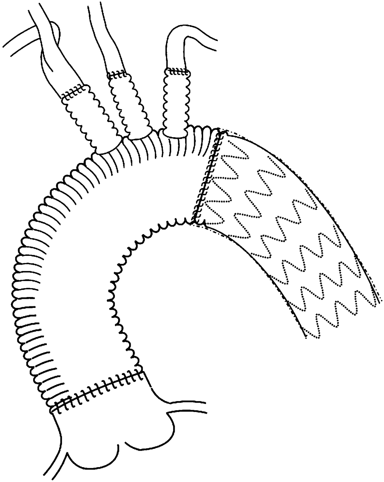 Built-in device for individualized branch stent type arch part reconstructed artificial blood vessel