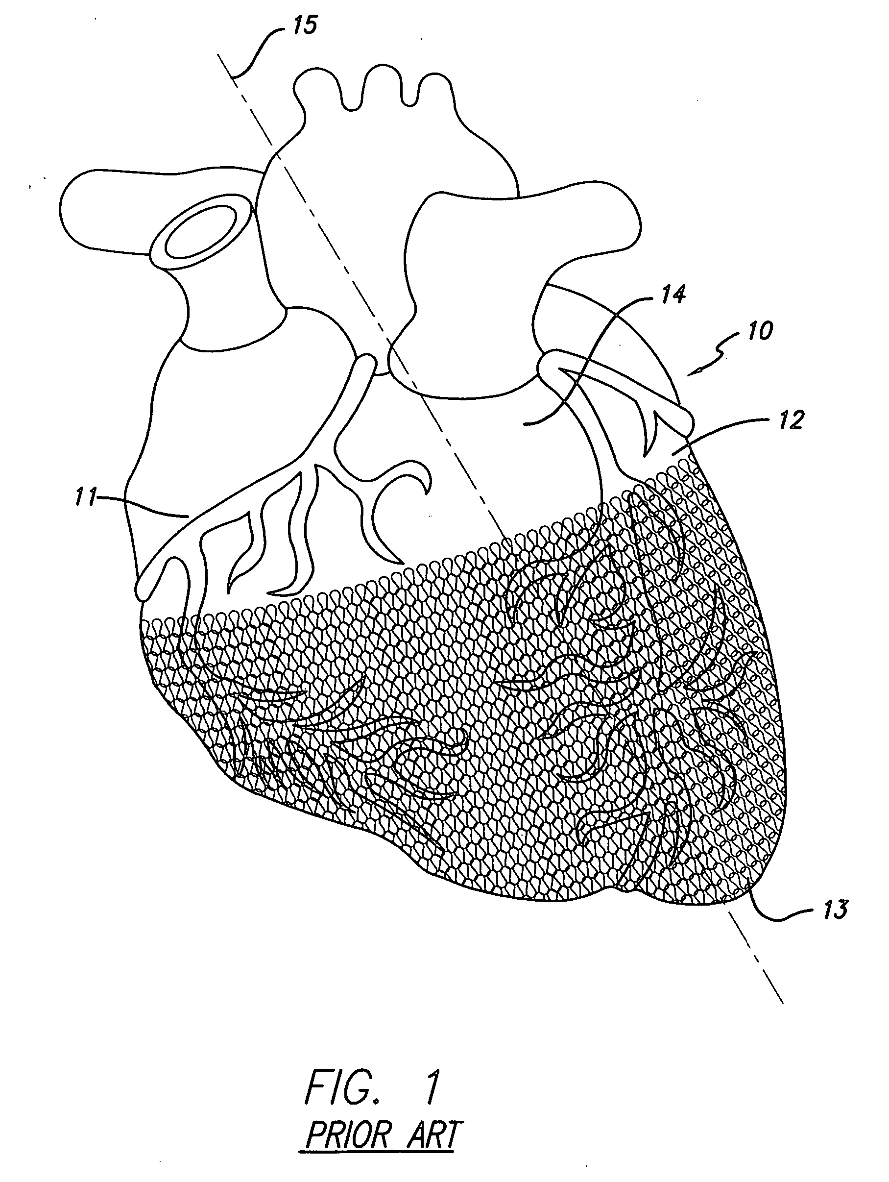 Cardiac harness having leadless electrodes for pacing and sensing therapy