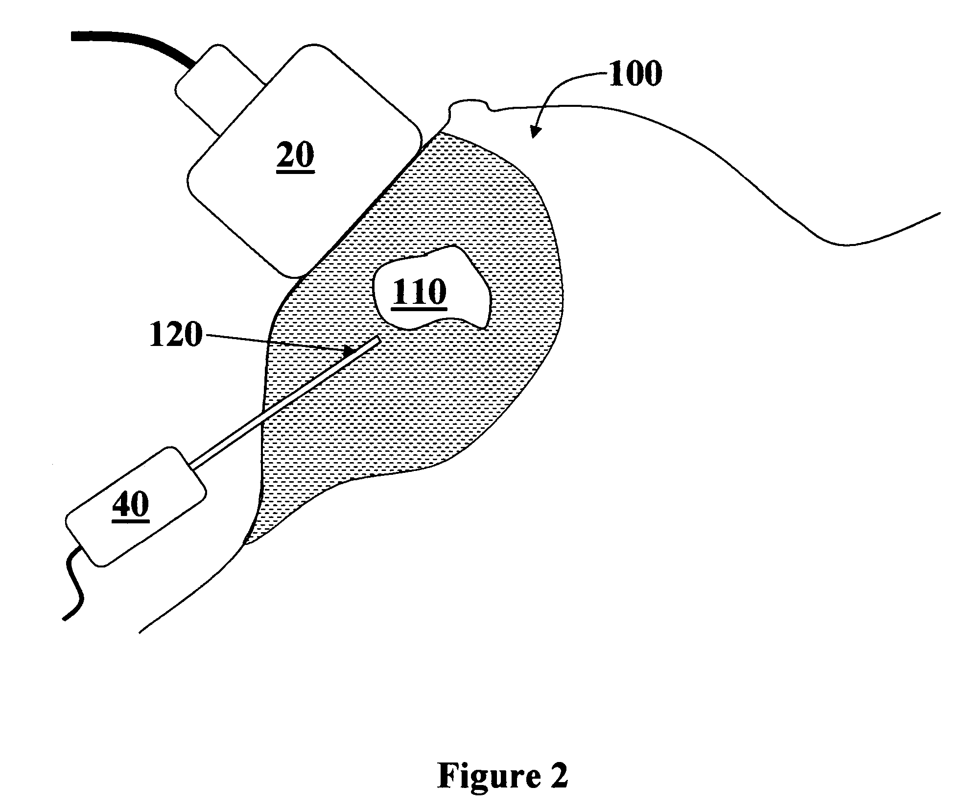 Ultrasound guided tissue measurement system