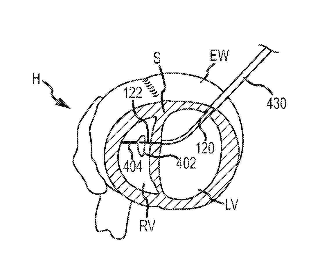 Heart anchor positioning devices, methods, and systems for treatment of congestive heart failure and other conditions