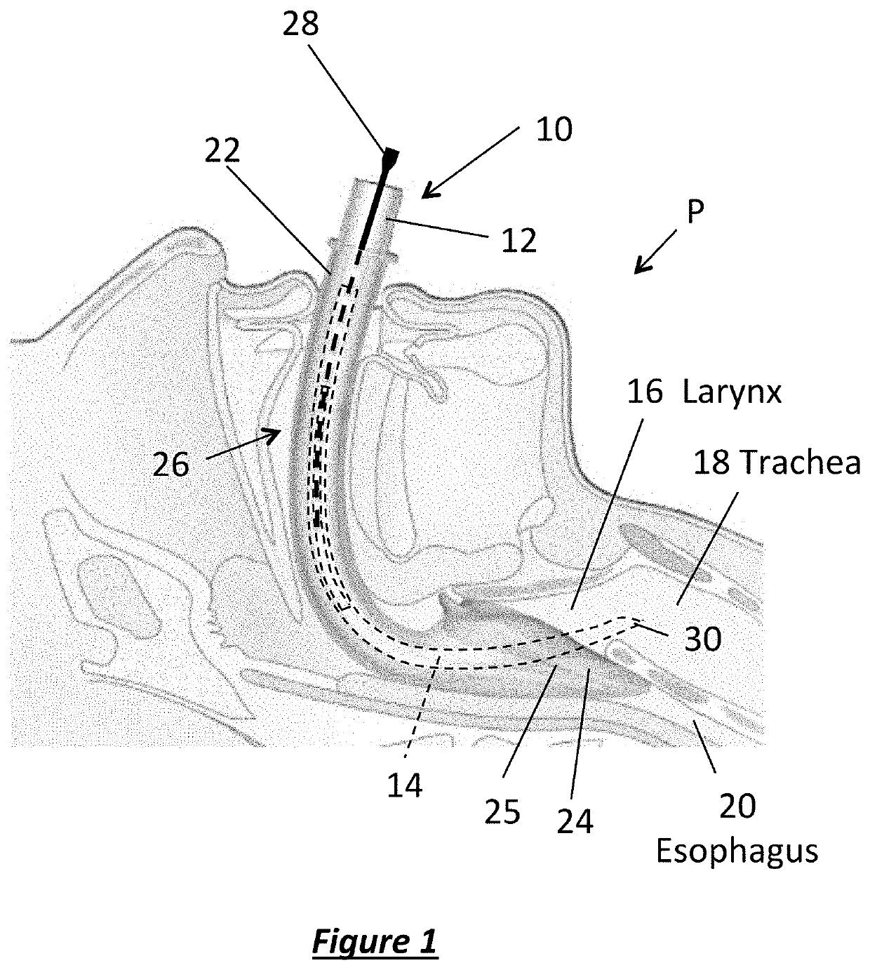 Intubation devices and methods of use