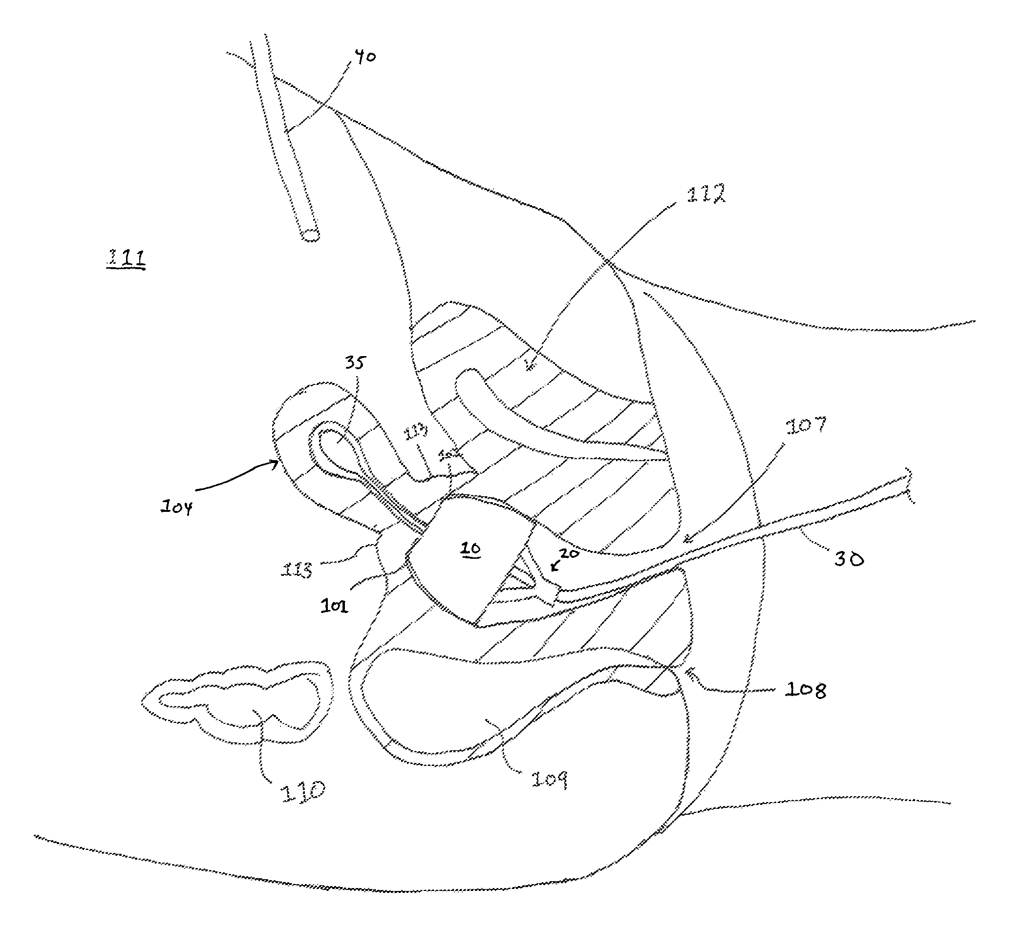 Fornix manipulator