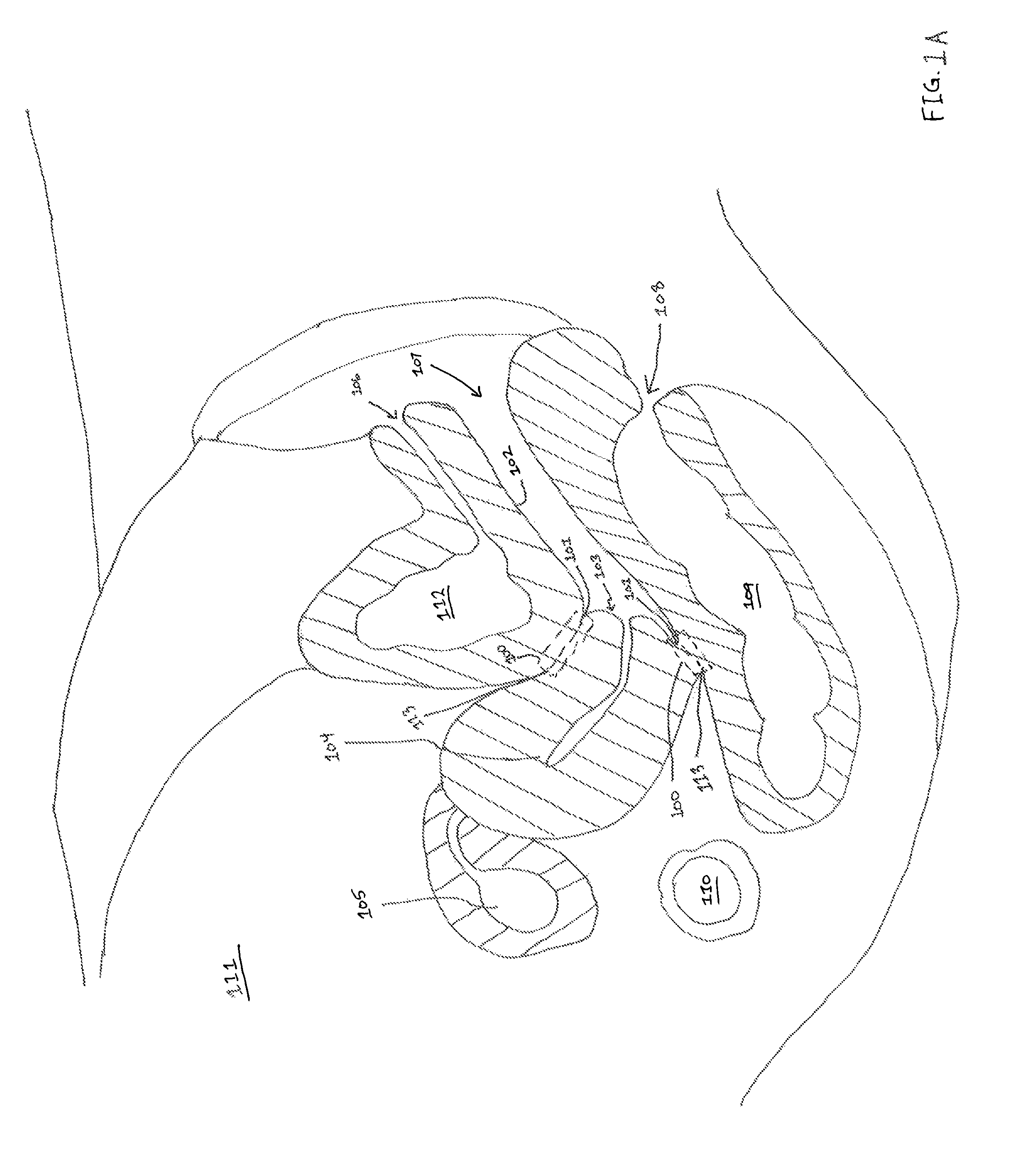 Fornix manipulator