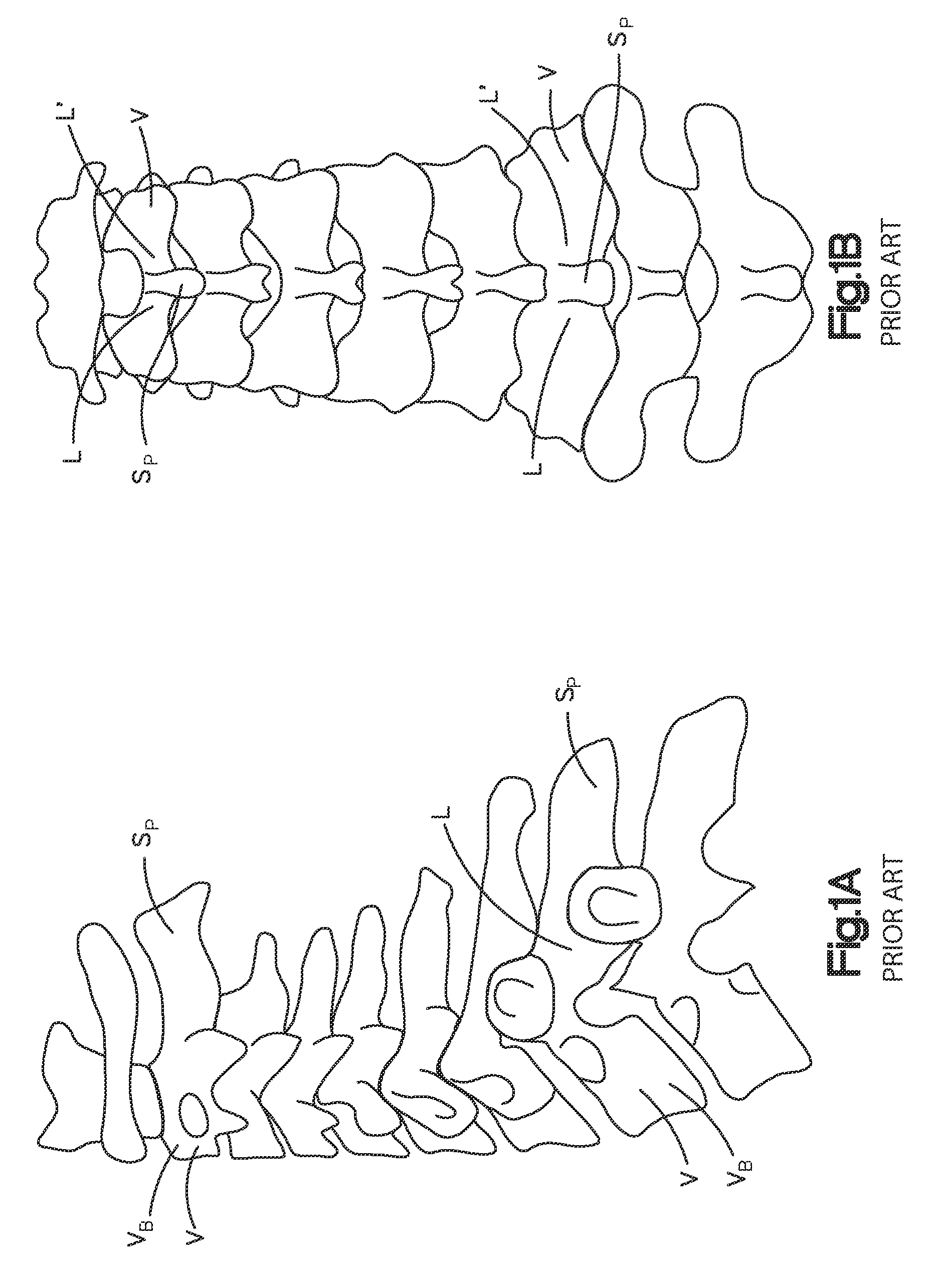 Spine stabilization system and method