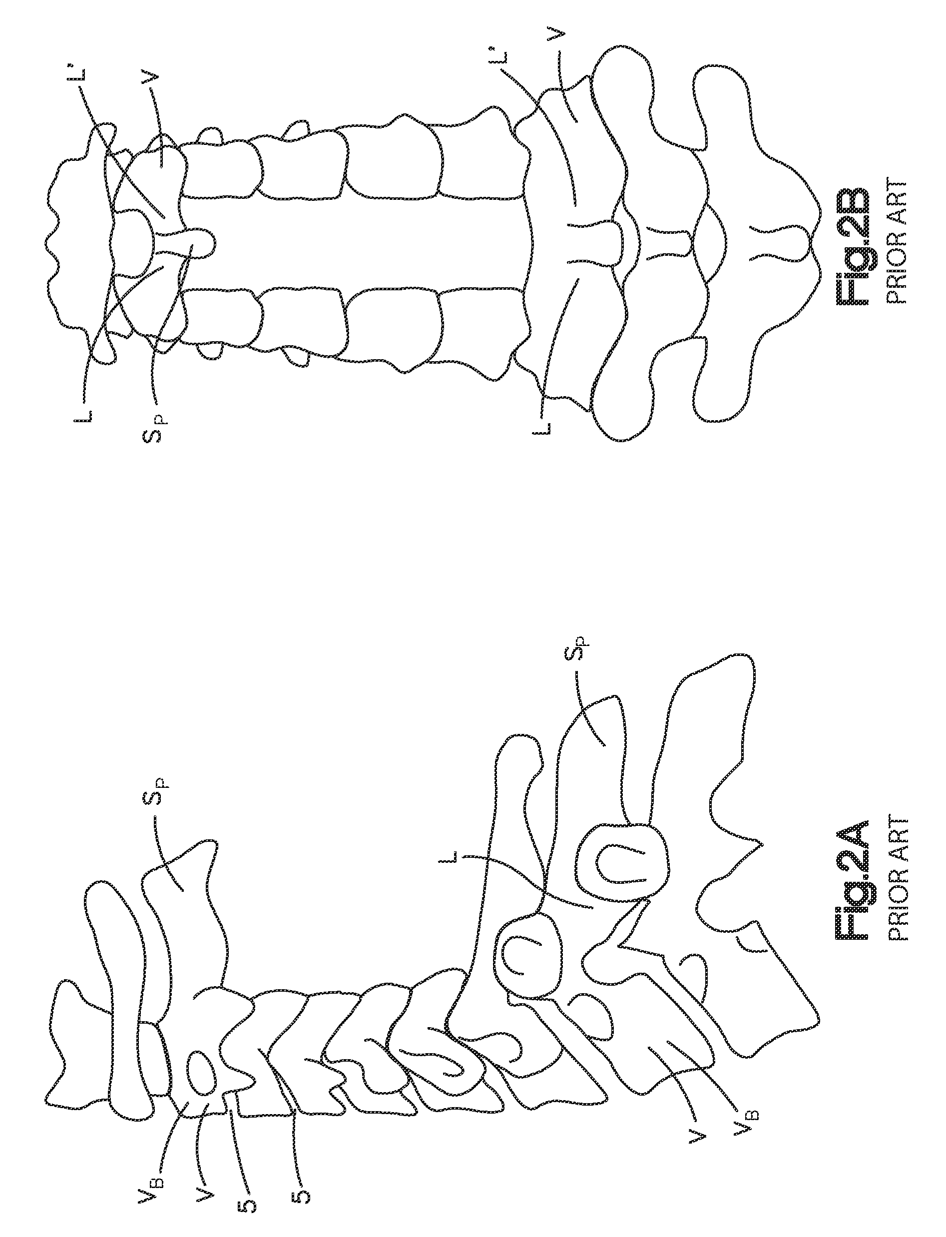 Spine stabilization system and method