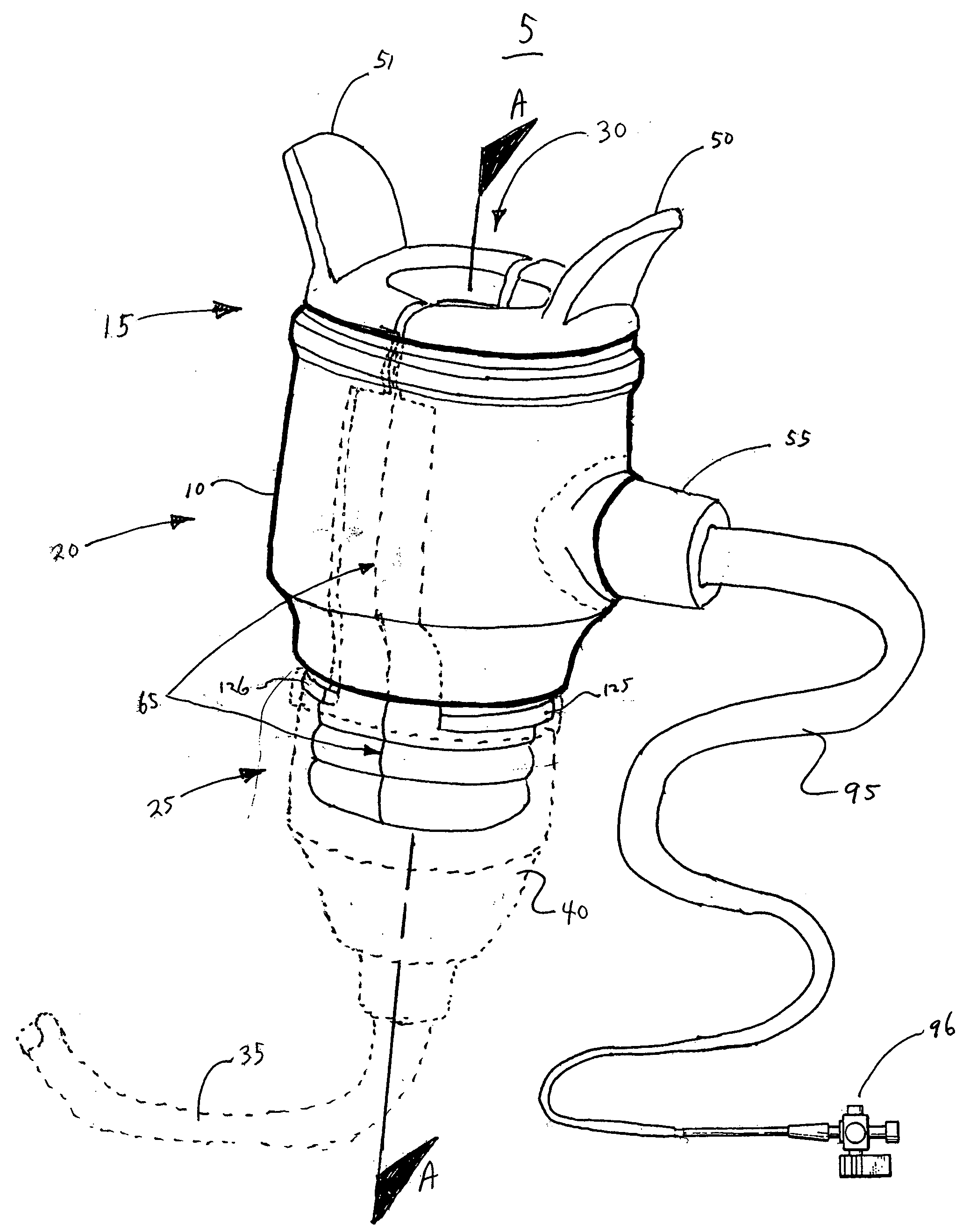 Splittable hemostasis valve