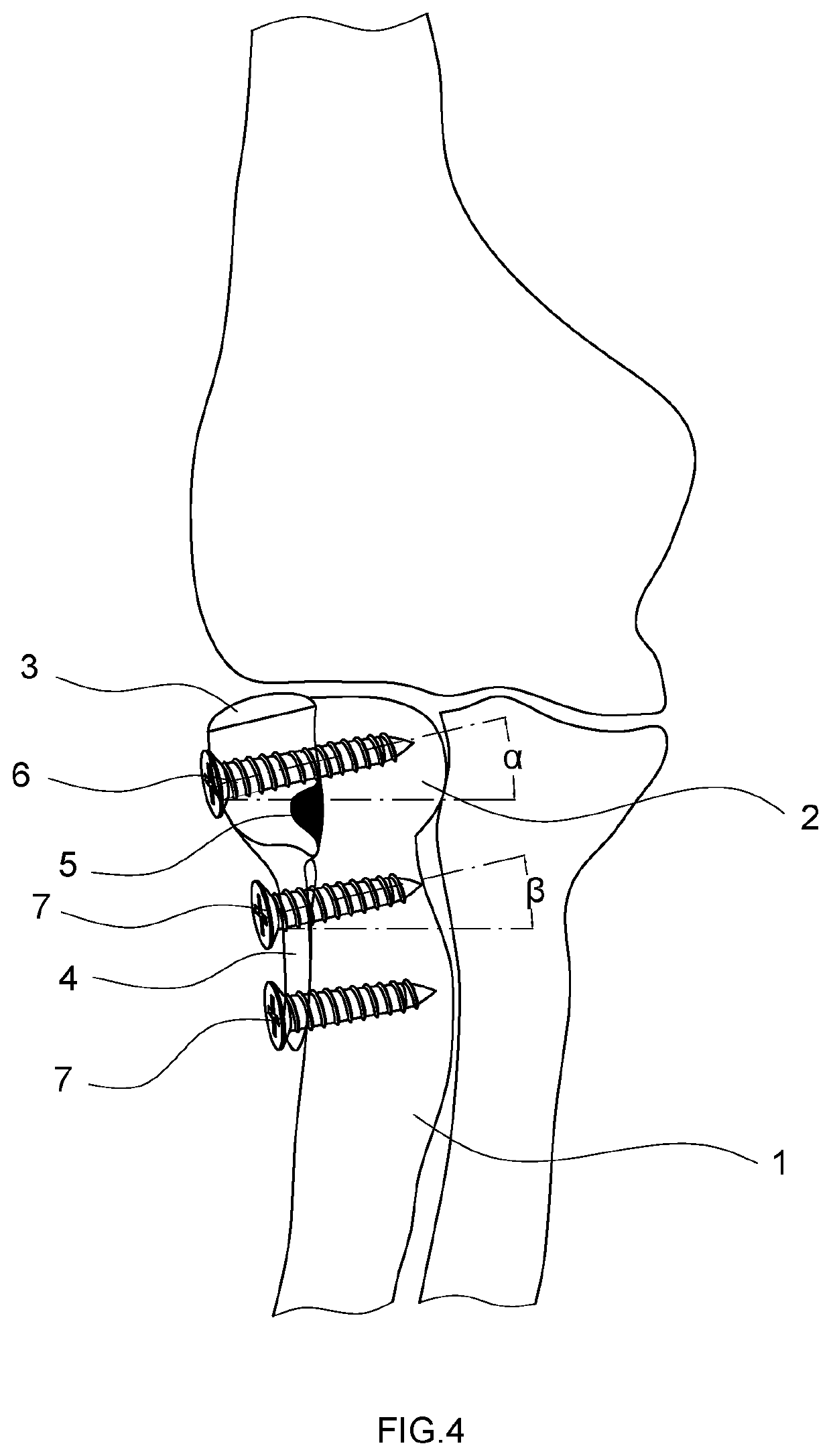 Semi-Radial Head Prosthesis