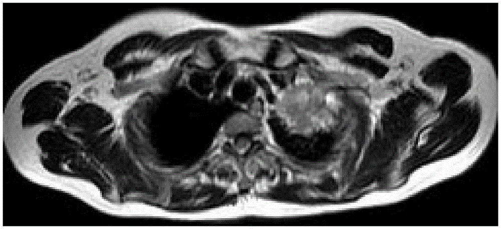 Lung malignant tumor MRI identification method utilizing maximum class separation distance method of genetic algorithm