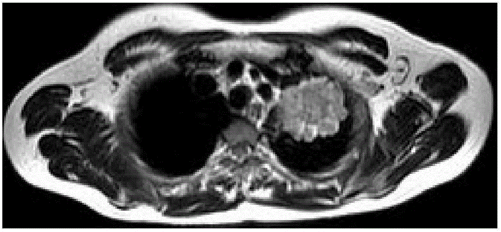 Lung malignant tumor MRI identification method utilizing maximum class separation distance method of genetic algorithm