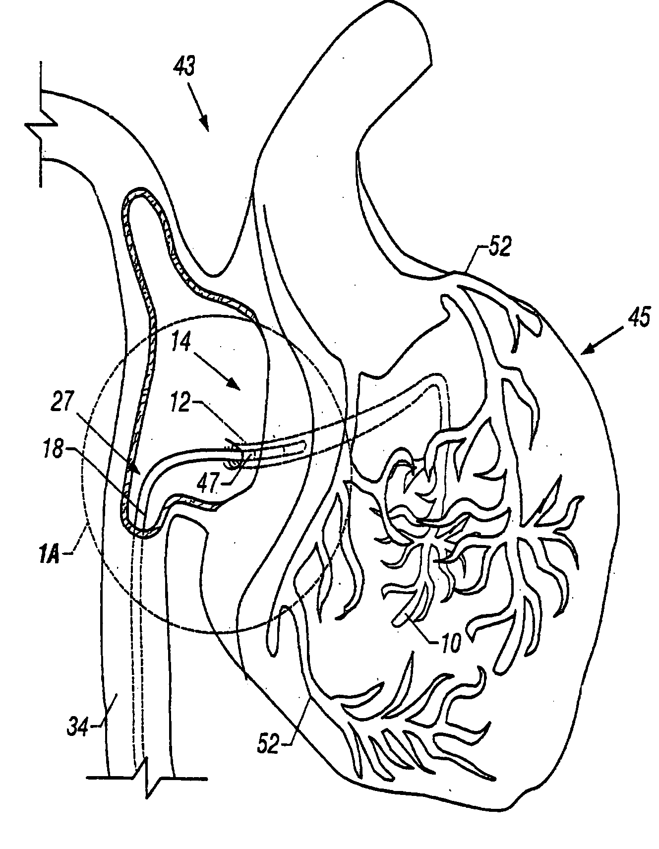 Method and apparatus to remove substances from vessels of the heart and other parts of the body to minimize or avoid renal or other harm or dysfunction