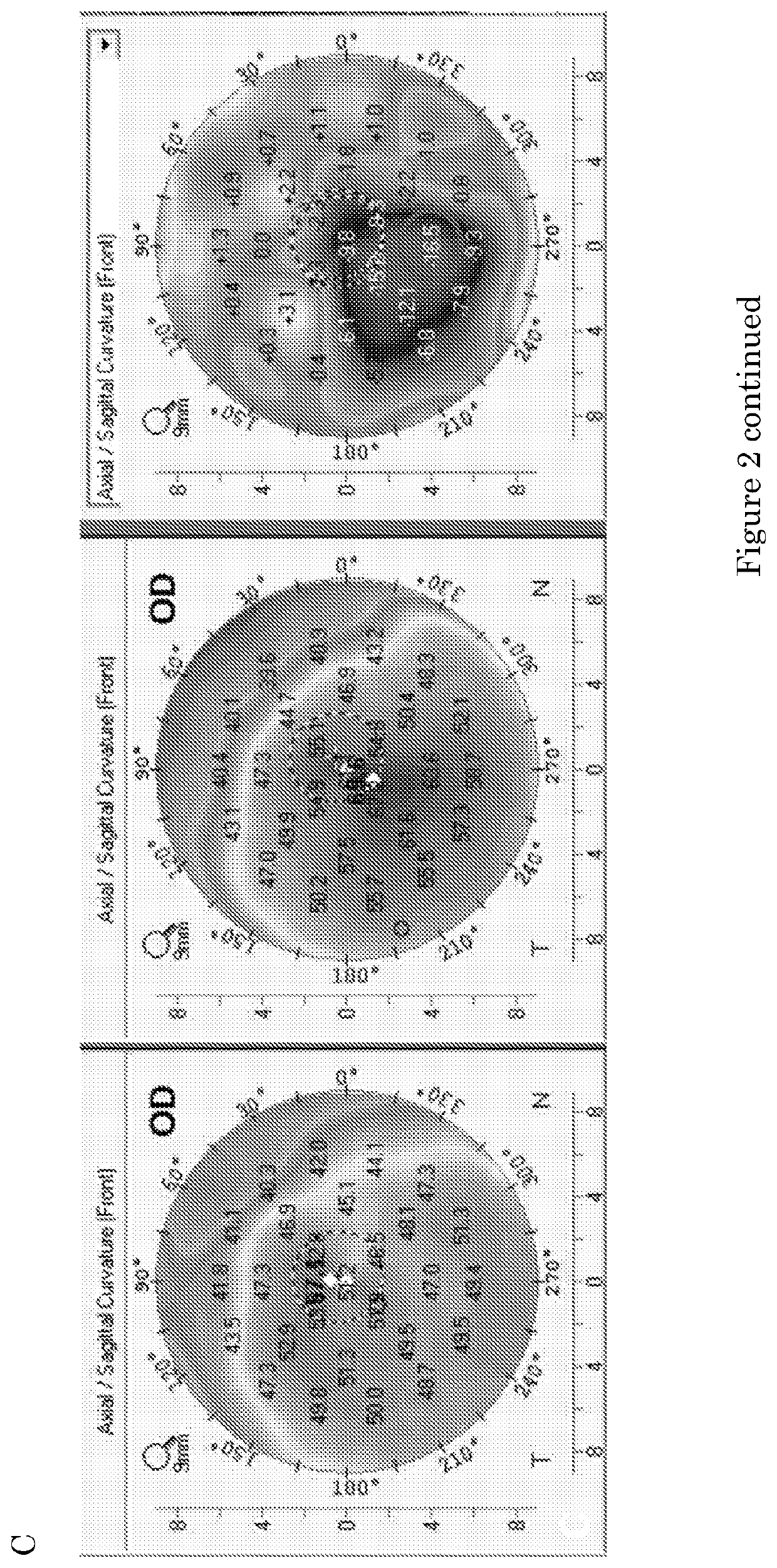 Donor overlay for treatment or alleviation of anterior corneal disorders