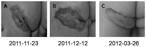 Novel application of itraconazole