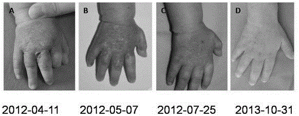 Novel application of itraconazole