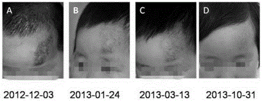 Novel application of itraconazole