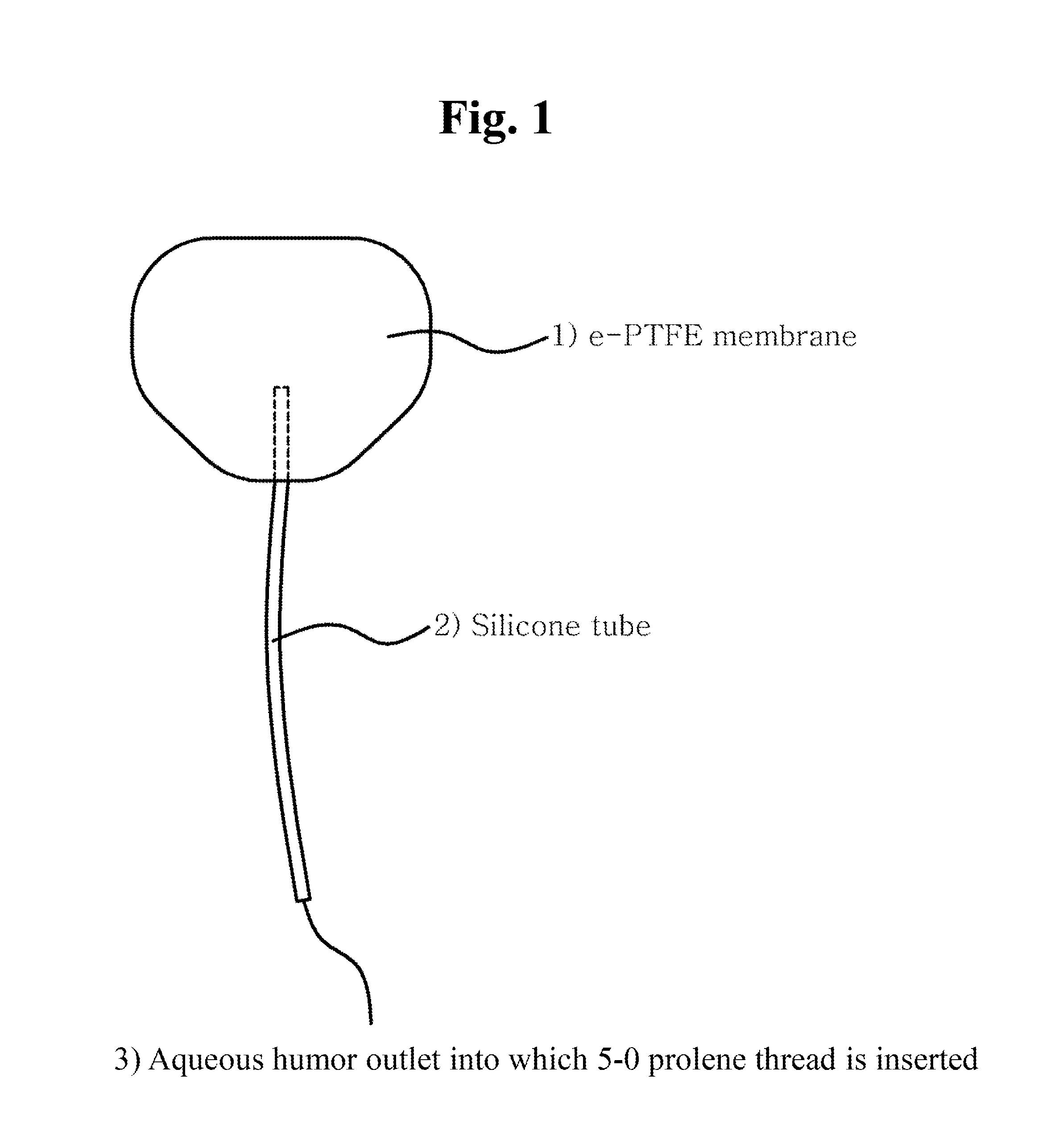 Device for treating ocular diseases caused by increased intraocular pressure