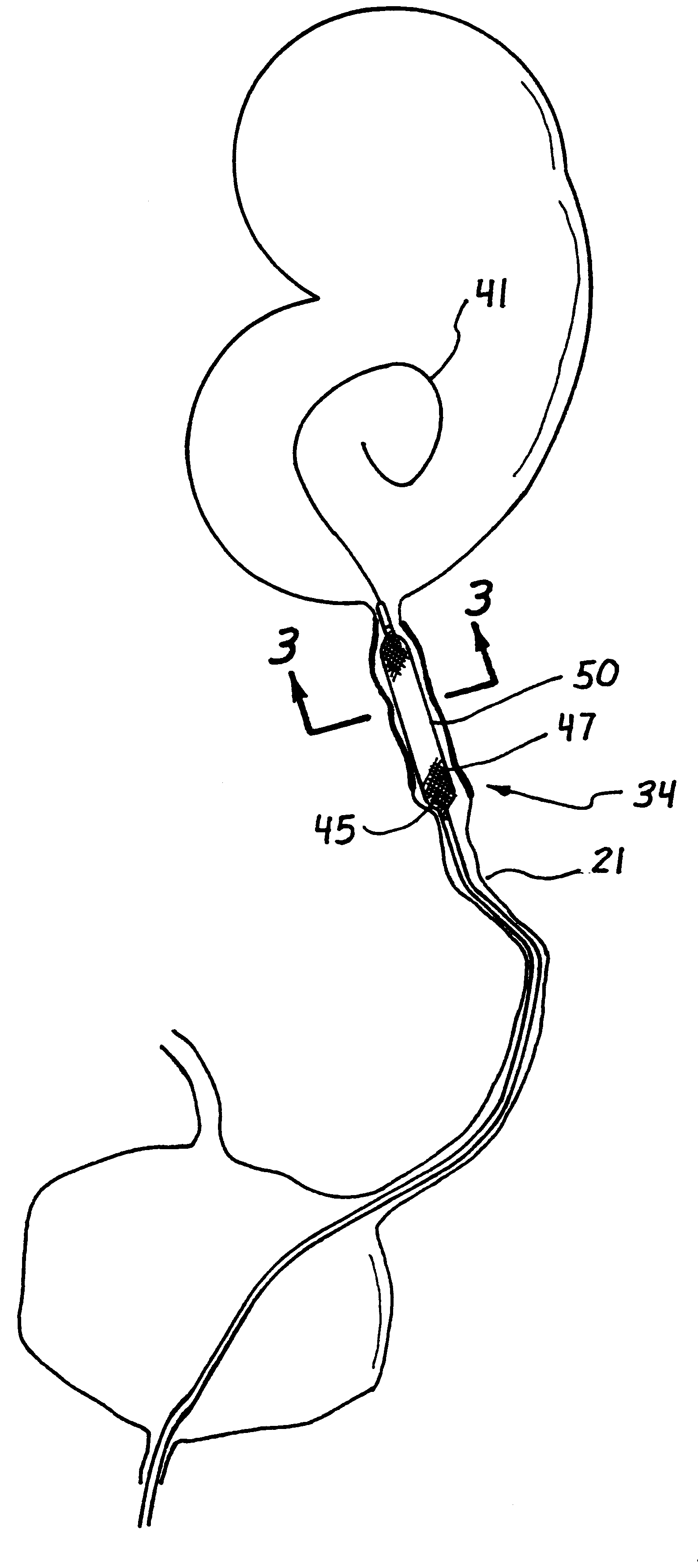 Electrosurgical catheter apparatus and method