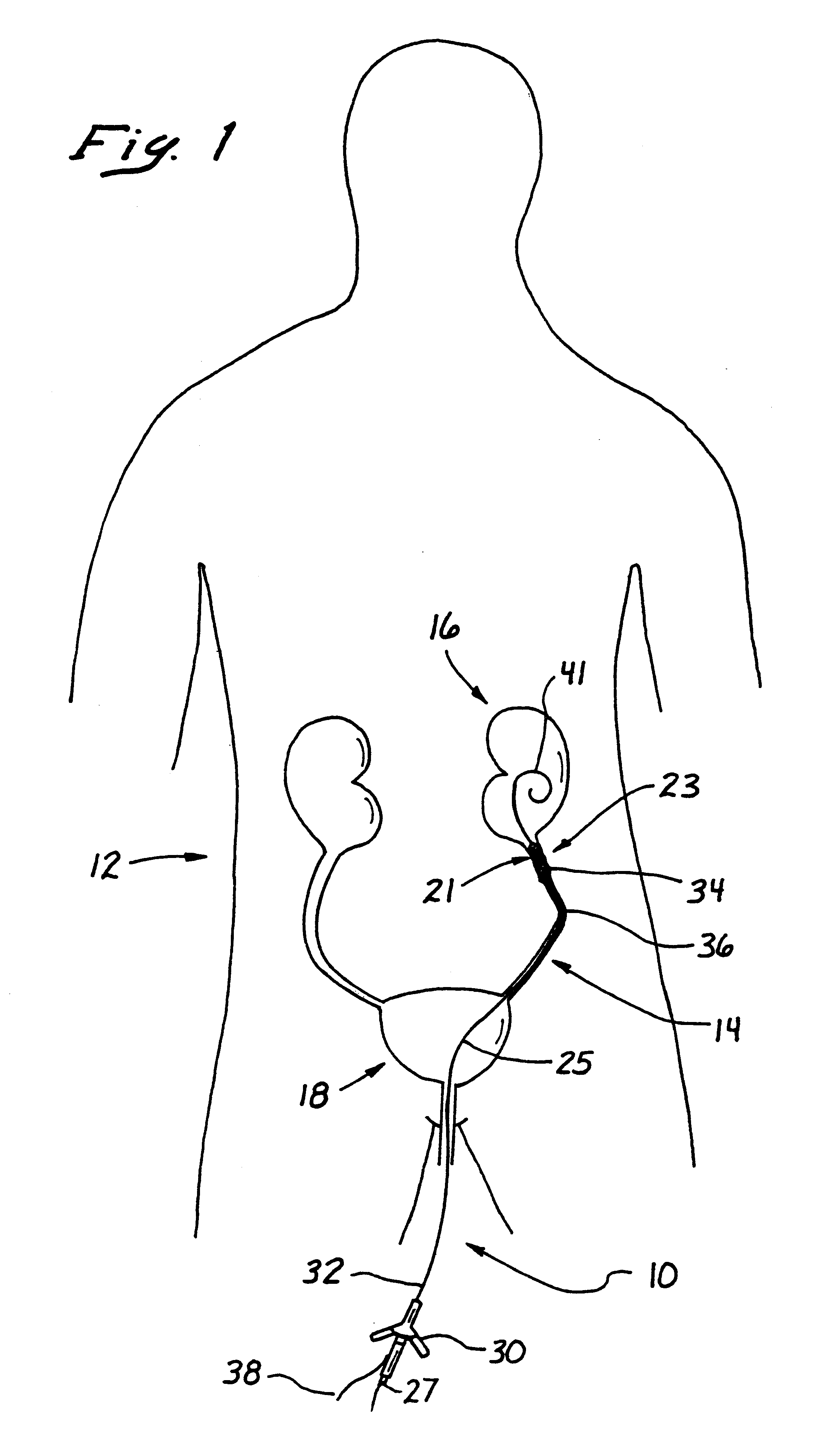 Electrosurgical catheter apparatus and method