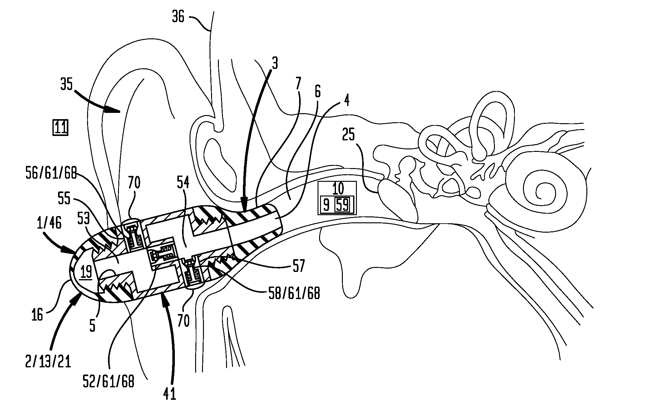 External Ear Canal Pressure Regulation Device