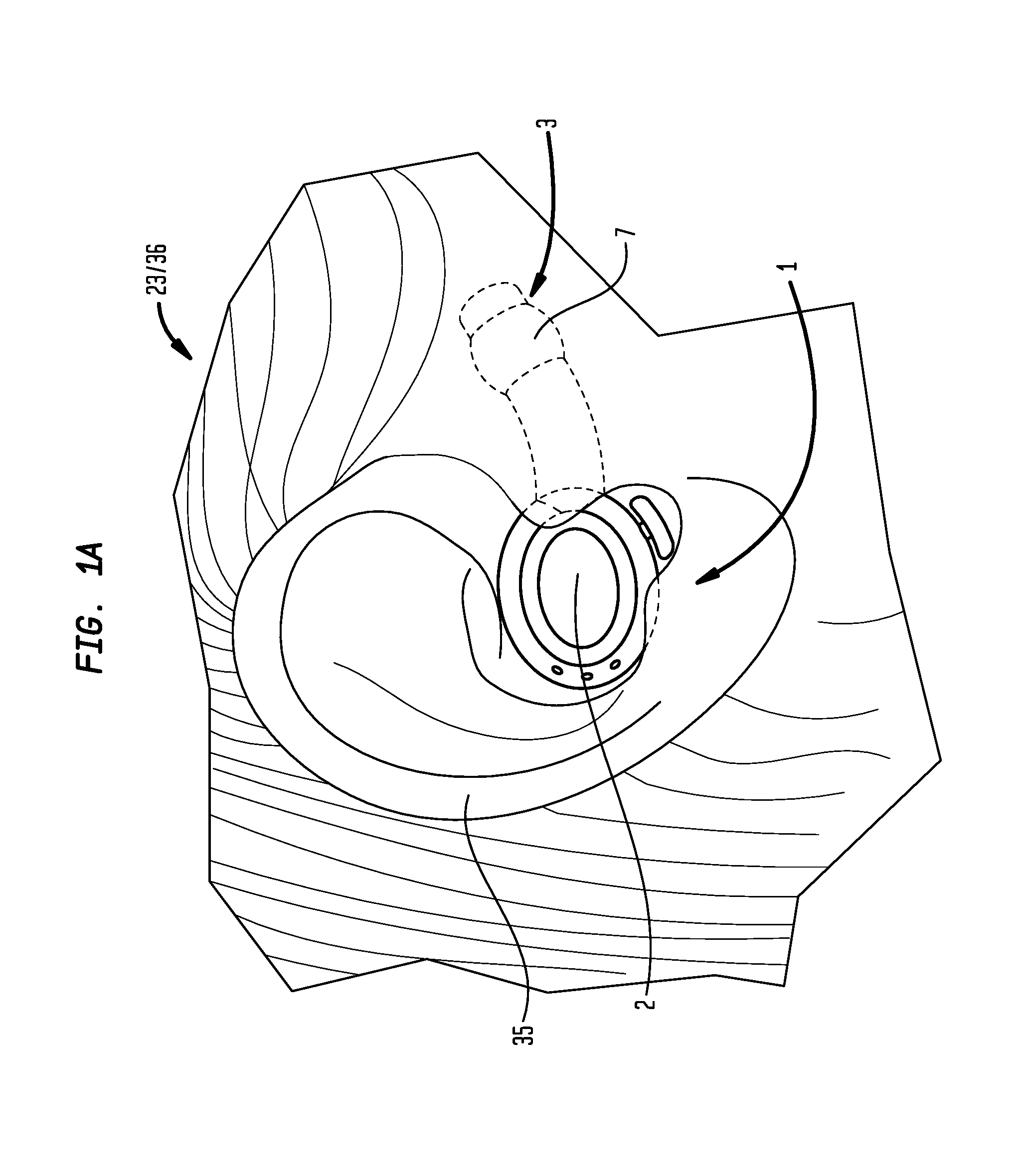 External Ear Canal Pressure Regulation Device