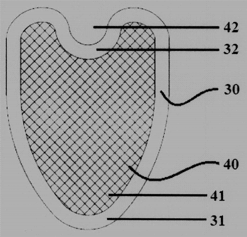 Special mesh for hiatal hernia