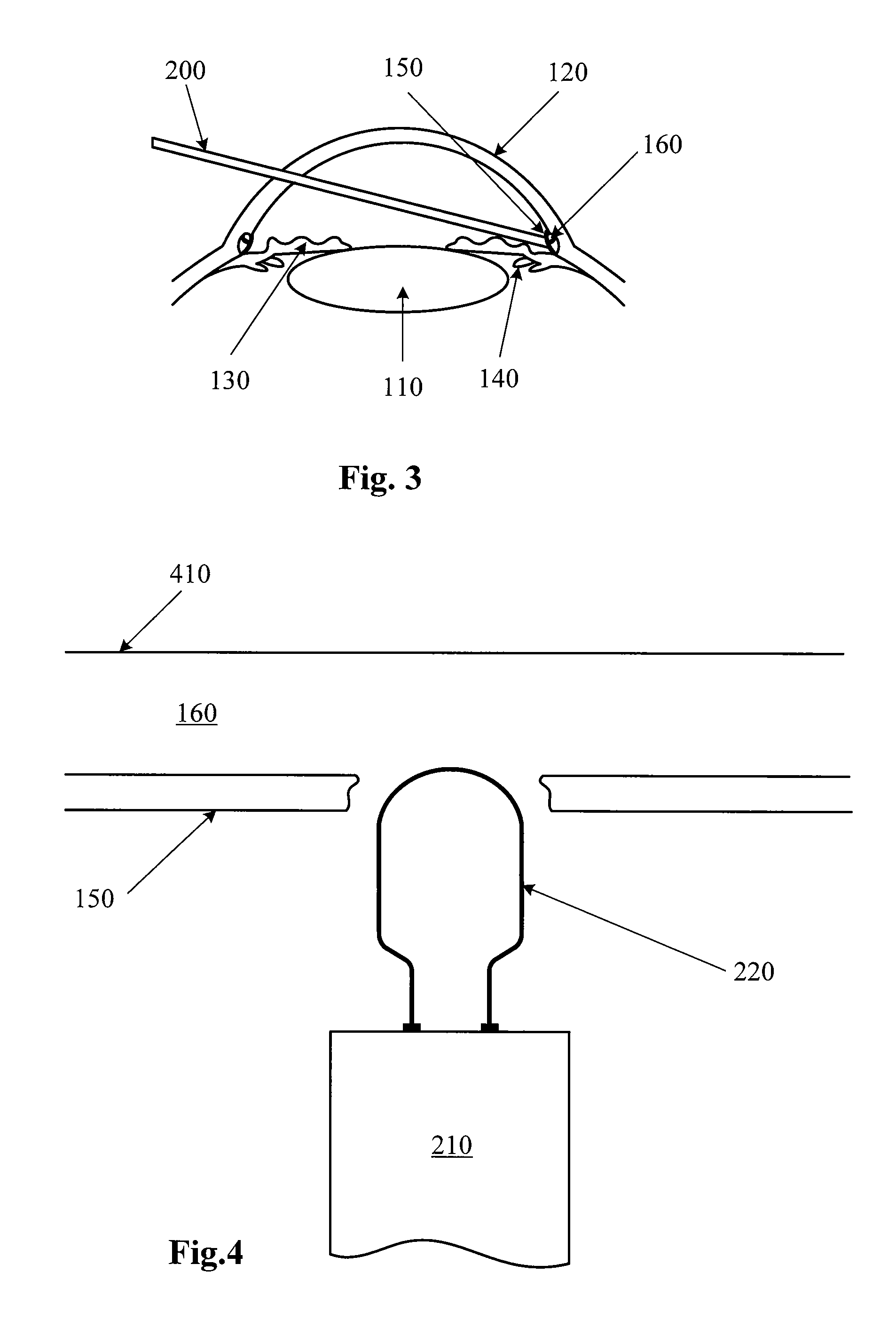 Small Gauge Ablation Probe For Glaucoma Surgery