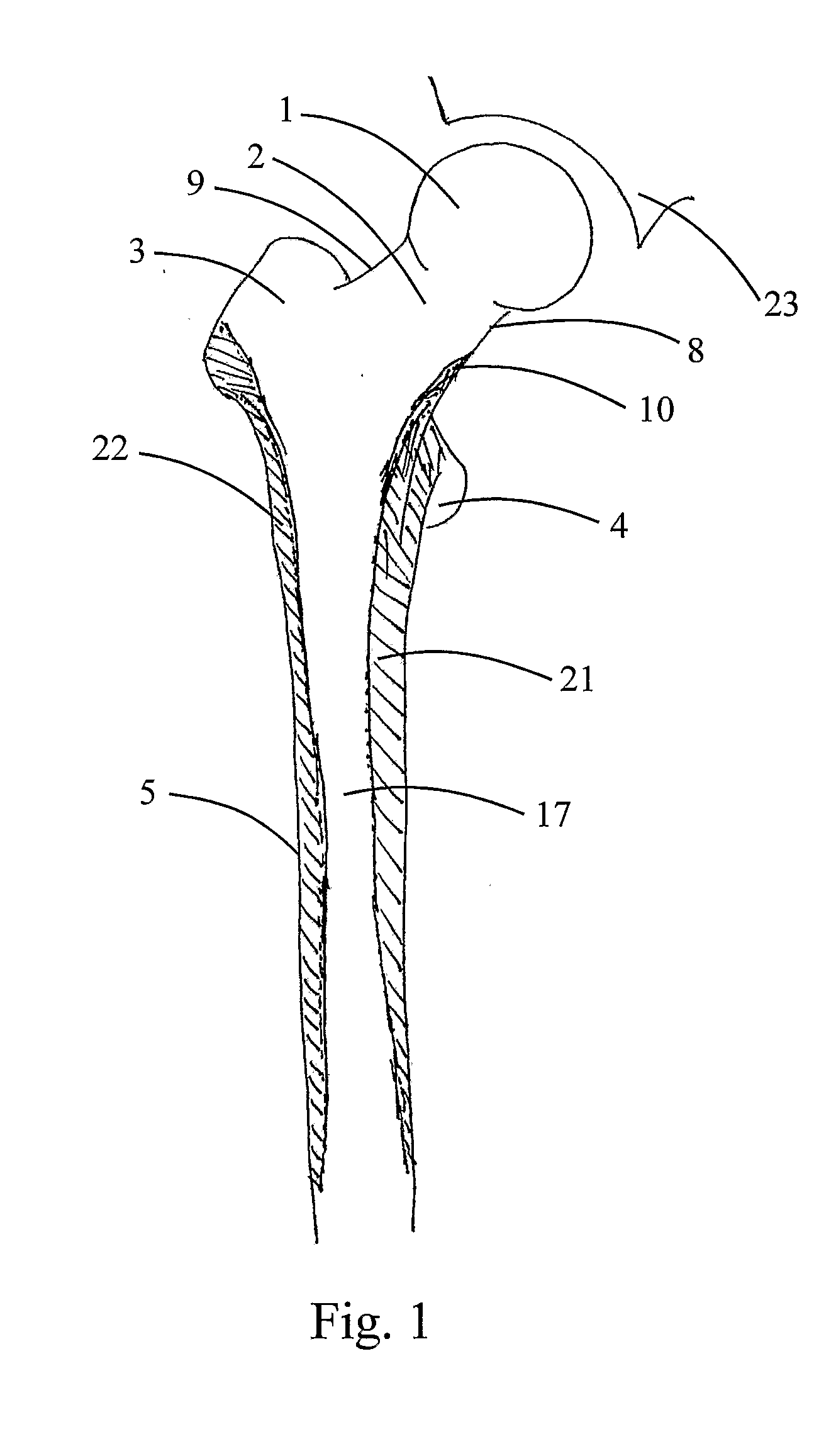 Implant assembly for proximal femoral fracture