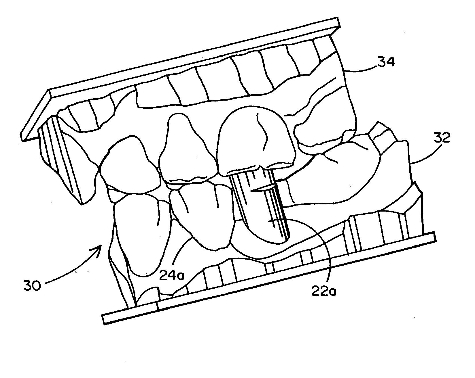 Method of Designing and Fabricating Patient-Specific Restorations from Intra-Oral Scanning of a Digital Impression Coping