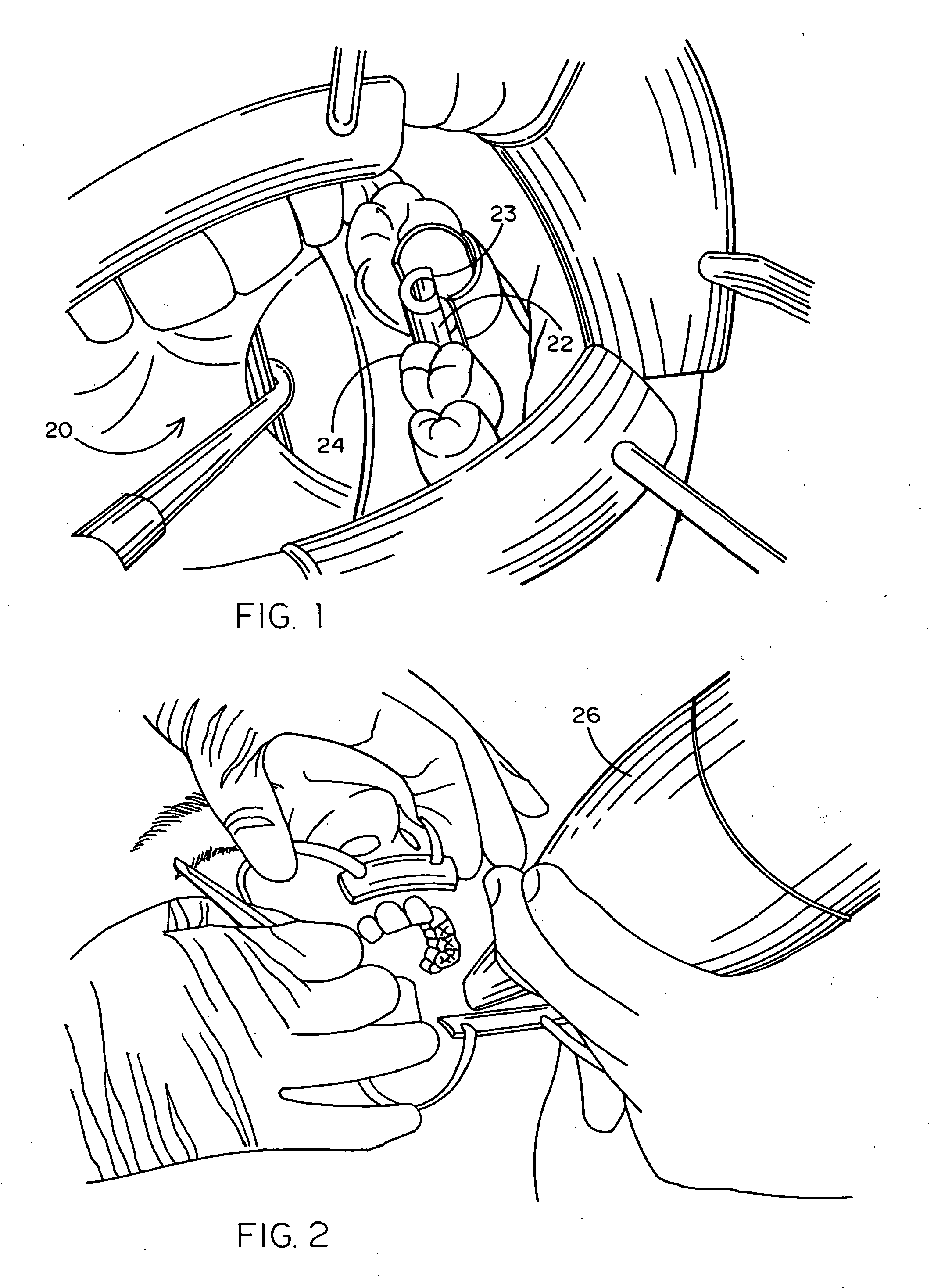 Method of Designing and Fabricating Patient-Specific Restorations from Intra-Oral Scanning of a Digital Impression Coping