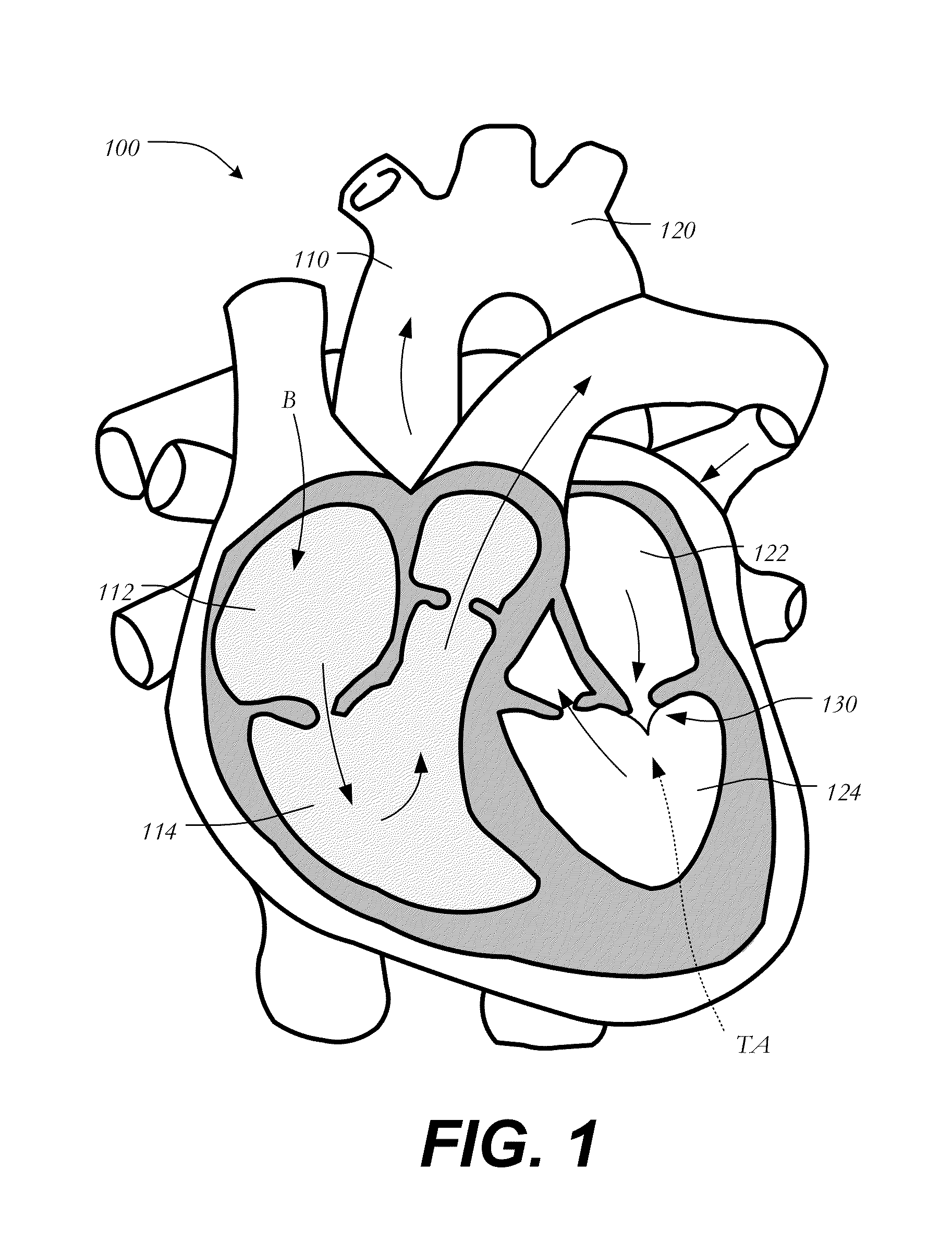 Transapical Mitral Valve Replacement