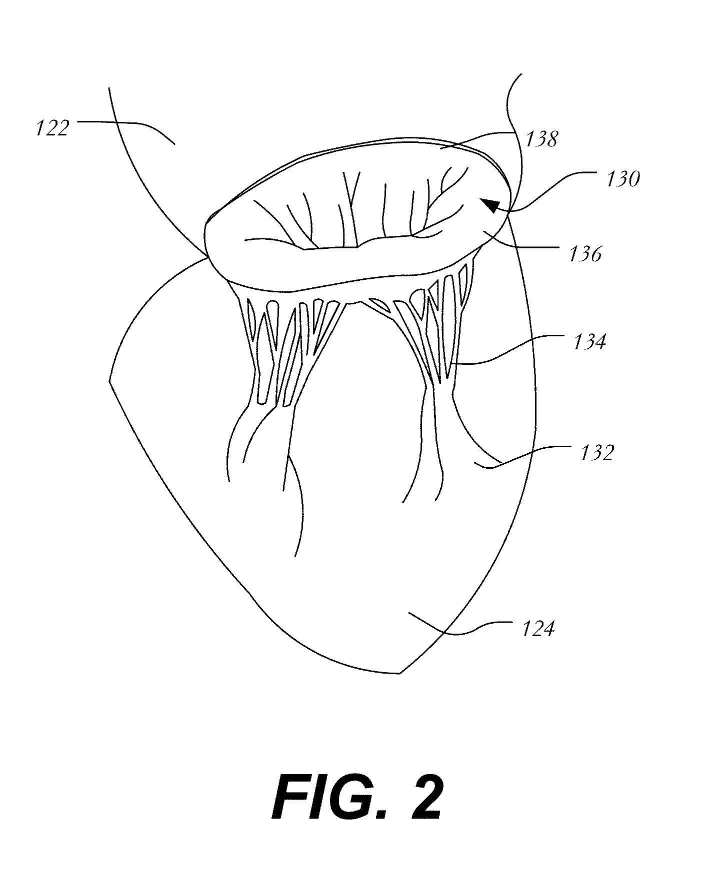 Transapical Mitral Valve Replacement