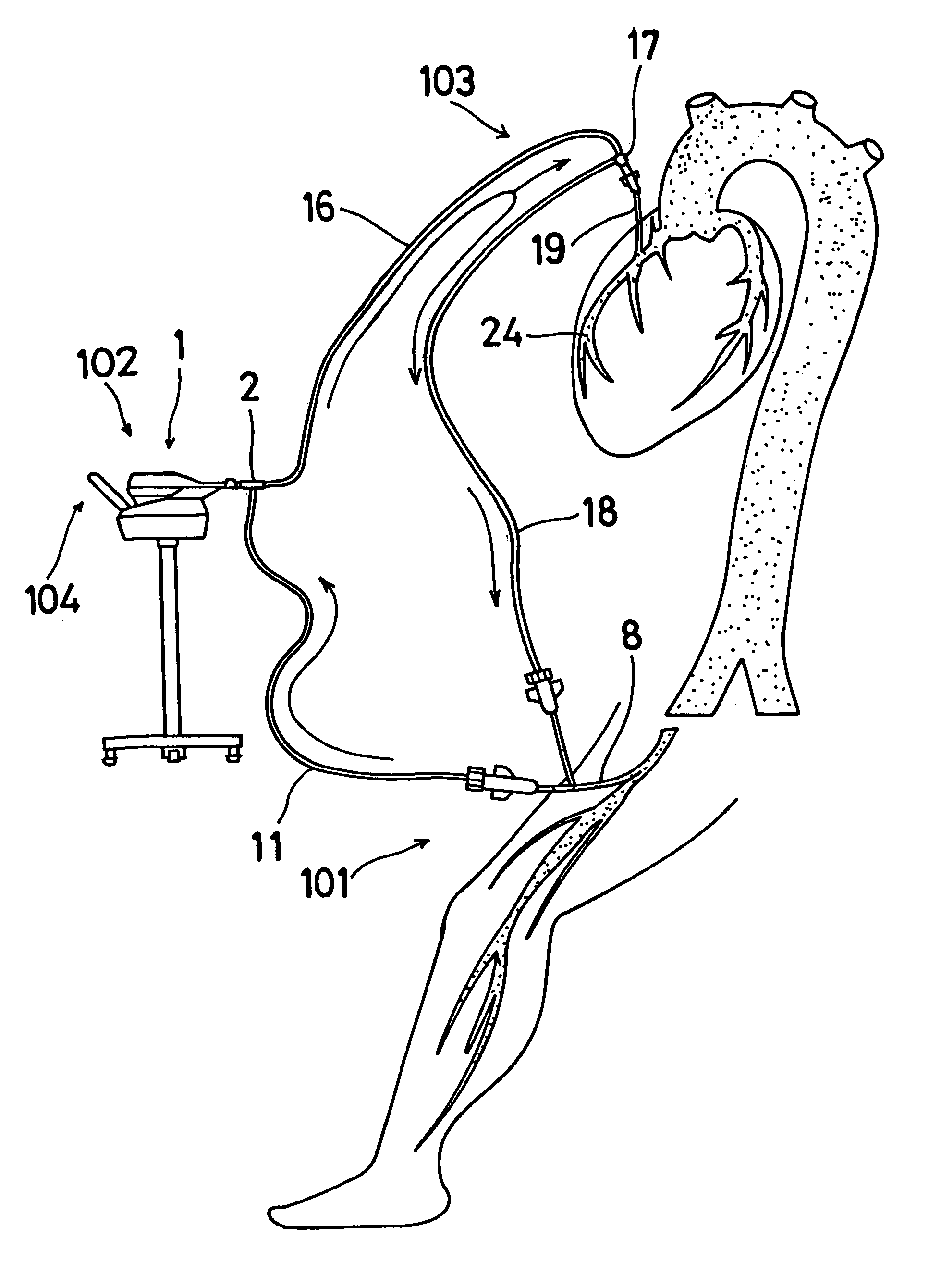 Perfusion system for off-pump coronary artery bypass