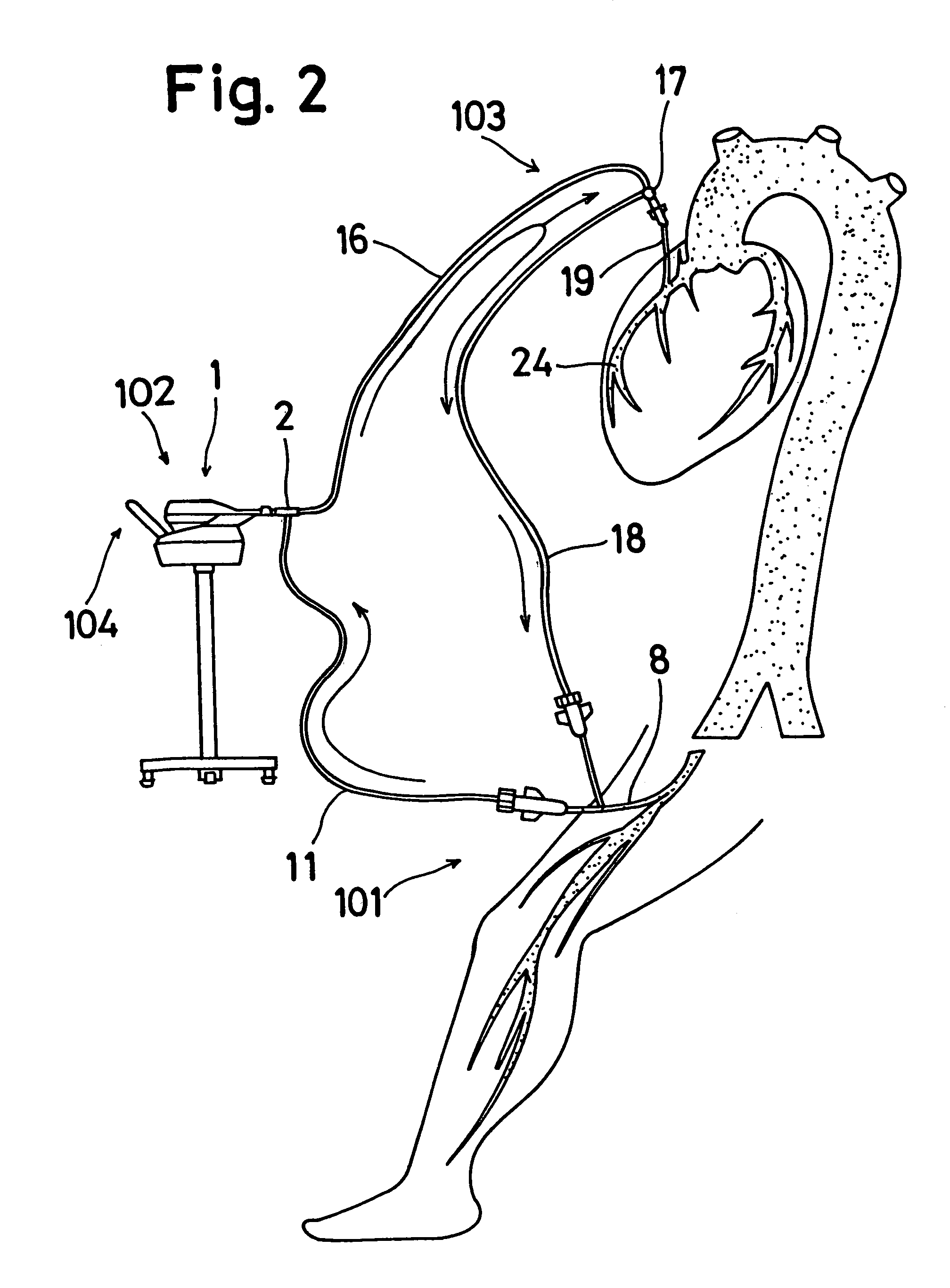 Perfusion system for off-pump coronary artery bypass