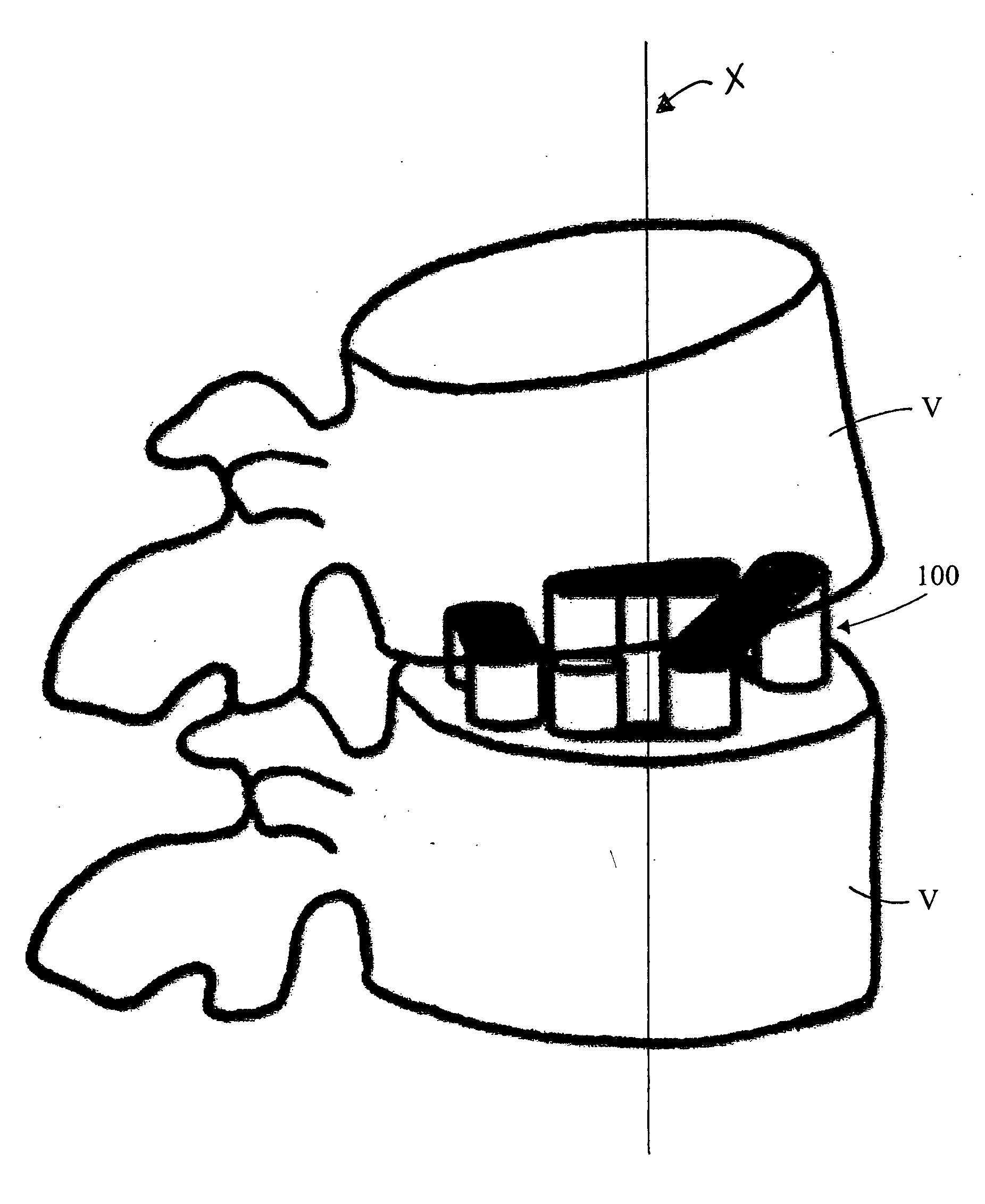 Support system for intervertebral fusion