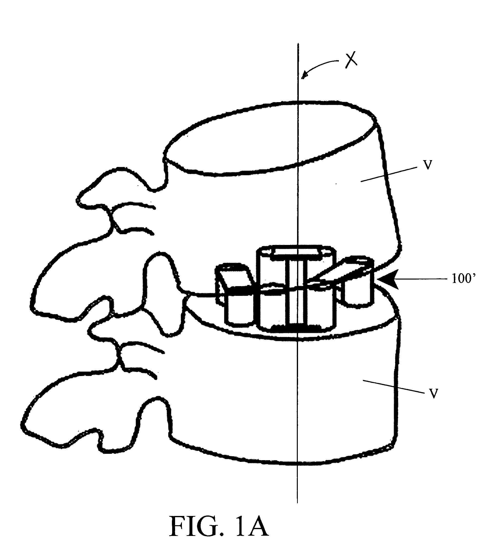 Support system for intervertebral fusion