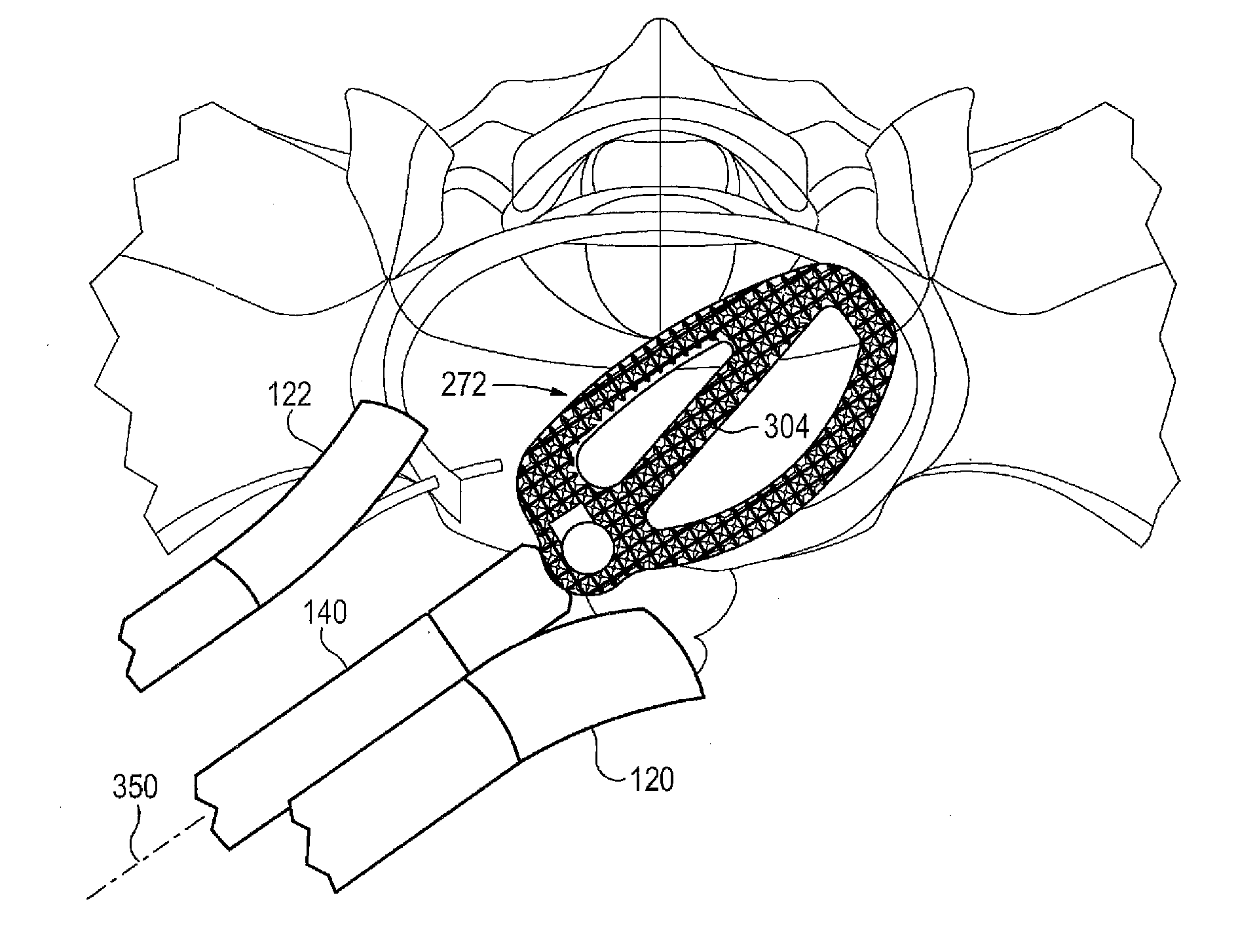 Method of retroperitoneal lateral insertion of spinal implants