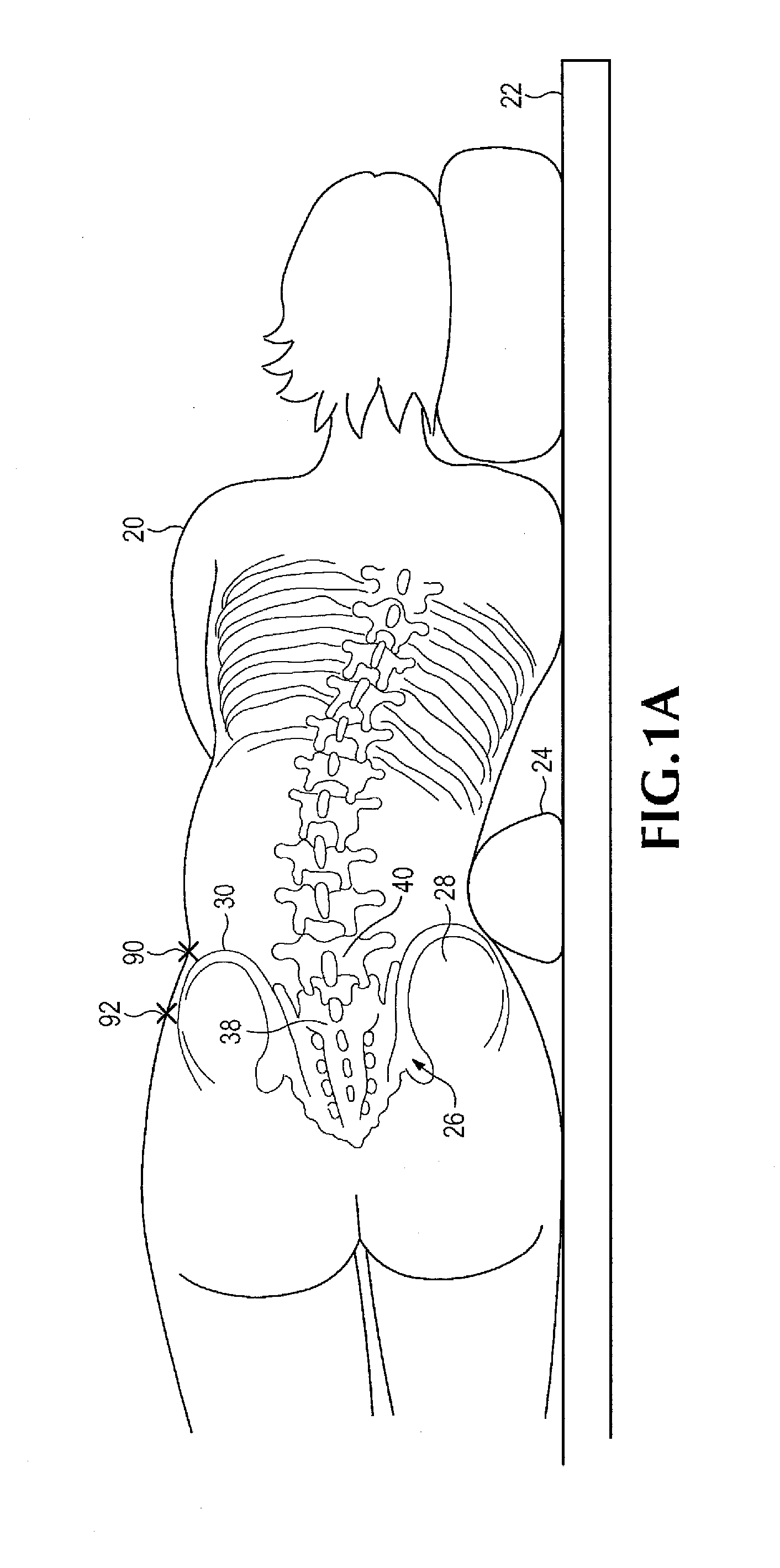 Method of retroperitoneal lateral insertion of spinal implants