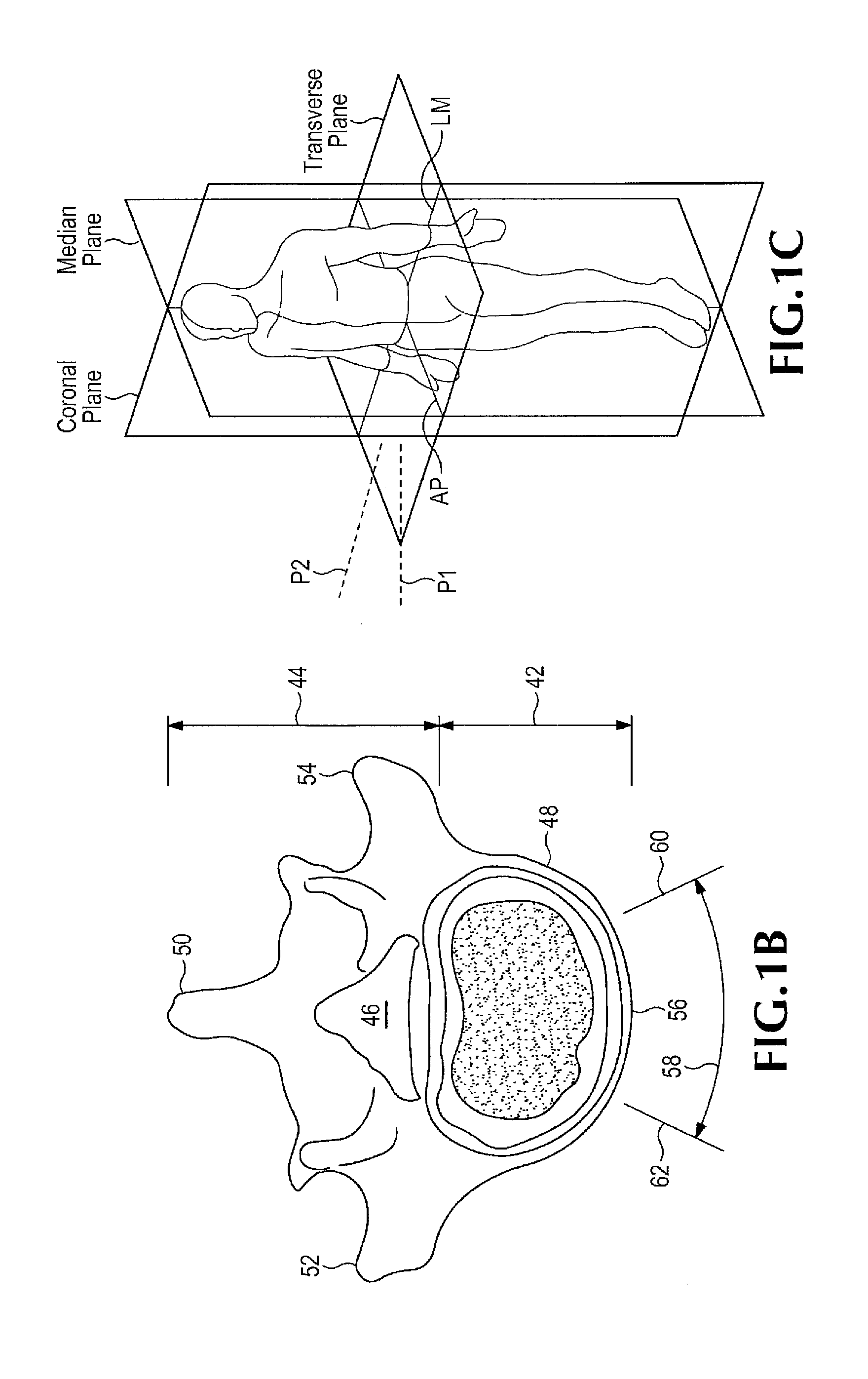 Method of retroperitoneal lateral insertion of spinal implants