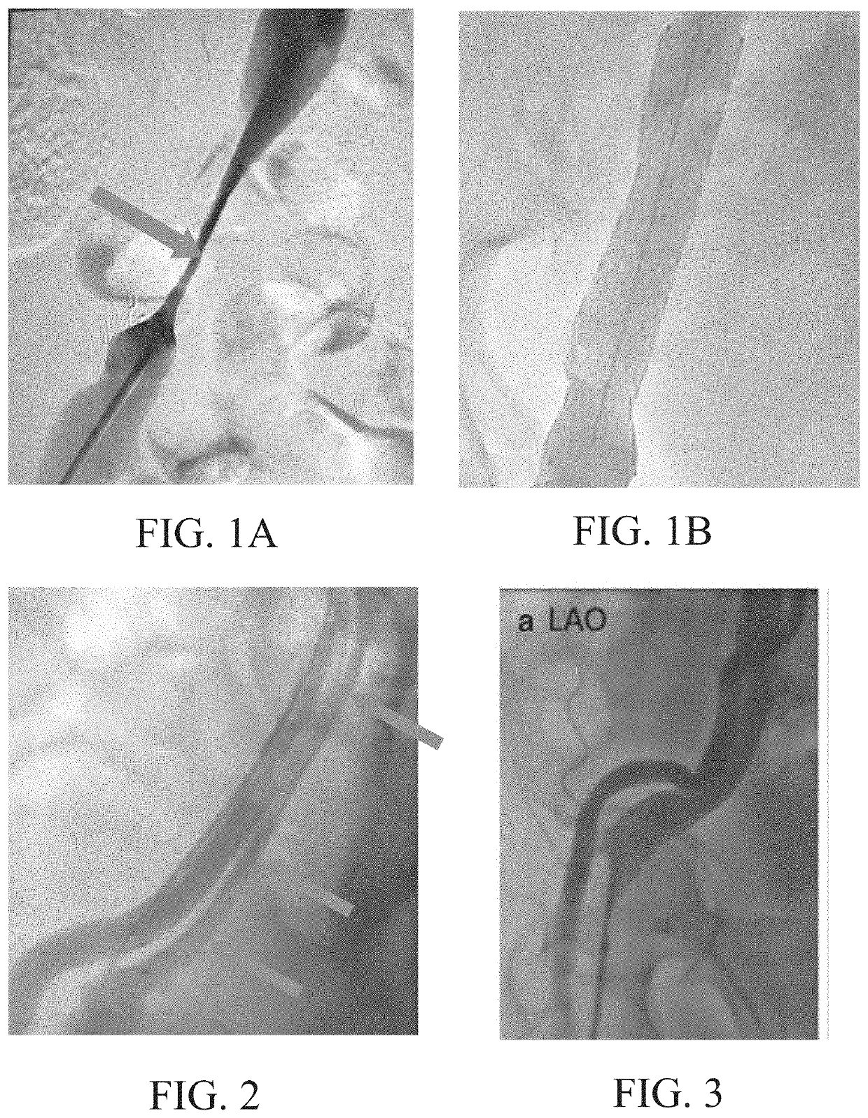 Apparatus and methods for treating venous compression/obstruction syndromes