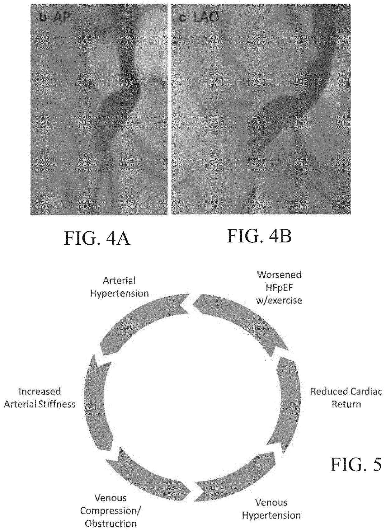 Apparatus and methods for treating venous compression/obstruction syndromes