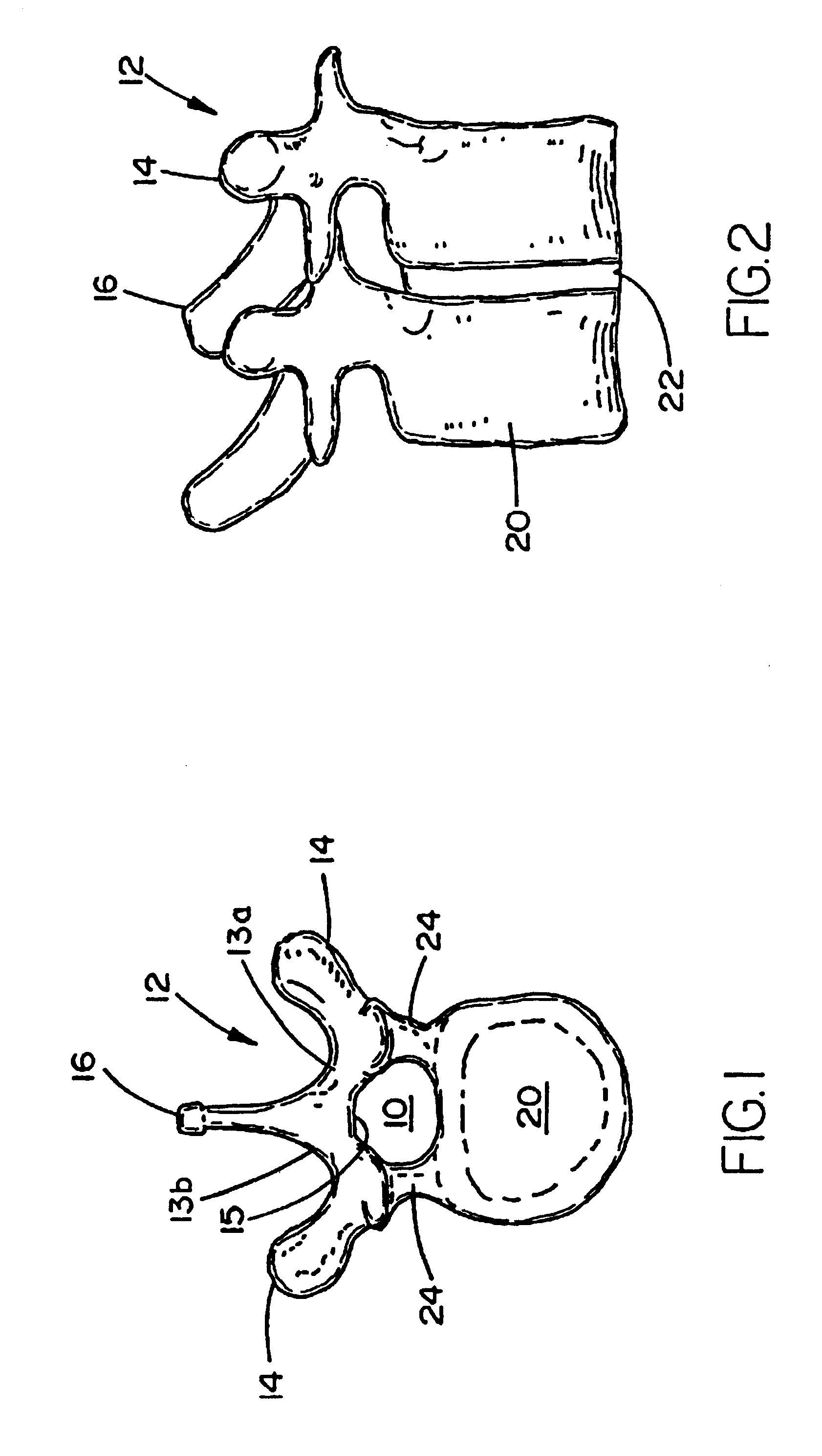 Polyaxial pedicle screw having a threaded and tapered compression locking mechanism