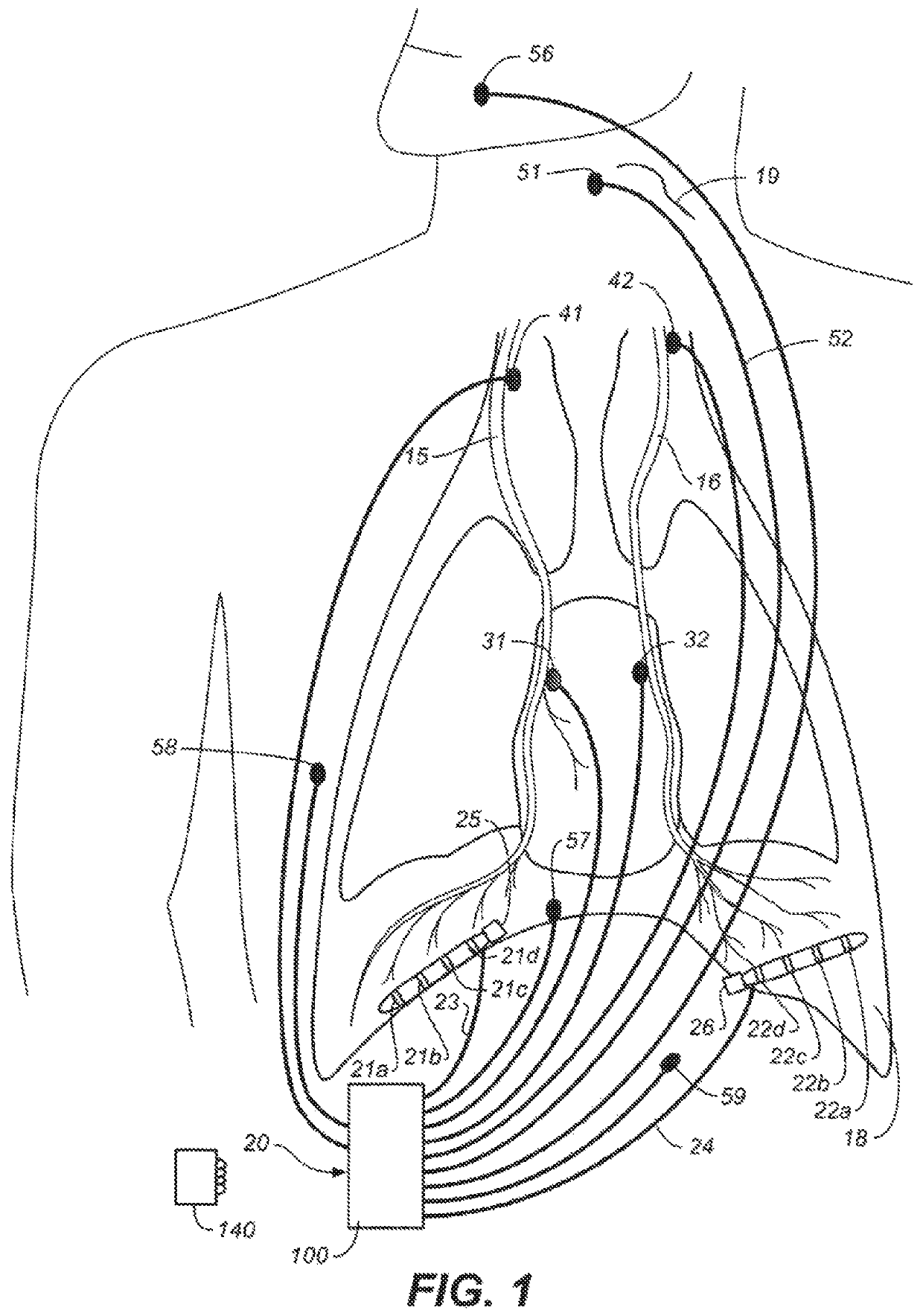 Airway diagnostics utilizing phrenic nerve stimulation device and method