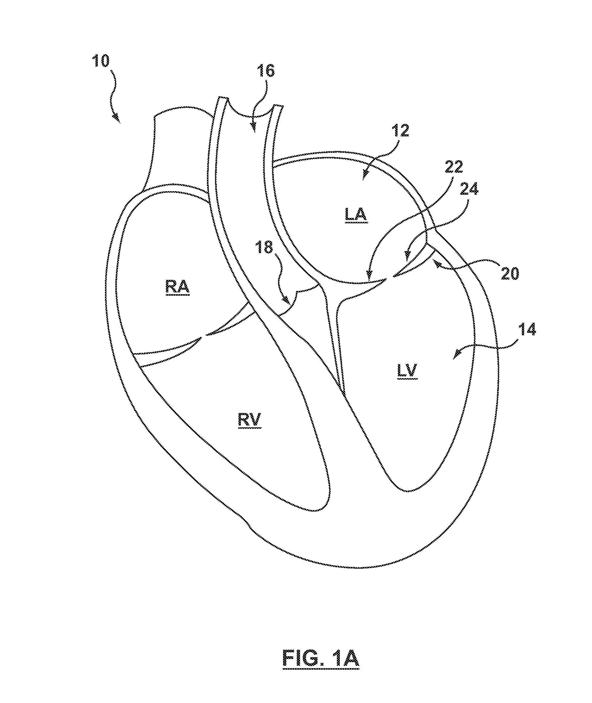 Helical coil mitral valve annuloplasty systems and methods