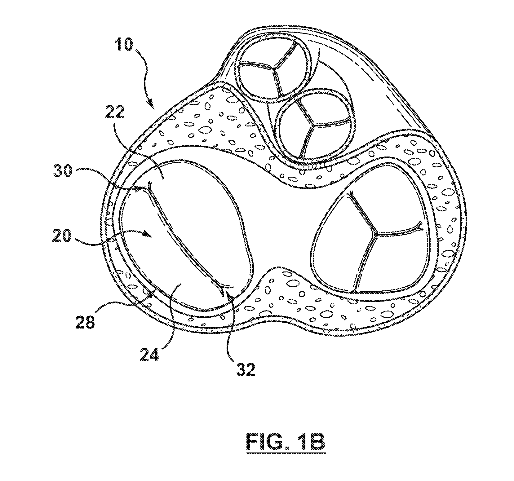 Helical coil mitral valve annuloplasty systems and methods