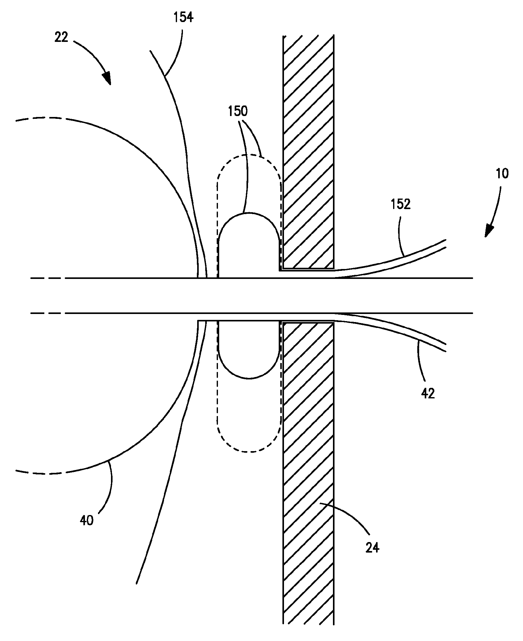 Temporary ostomy appliance