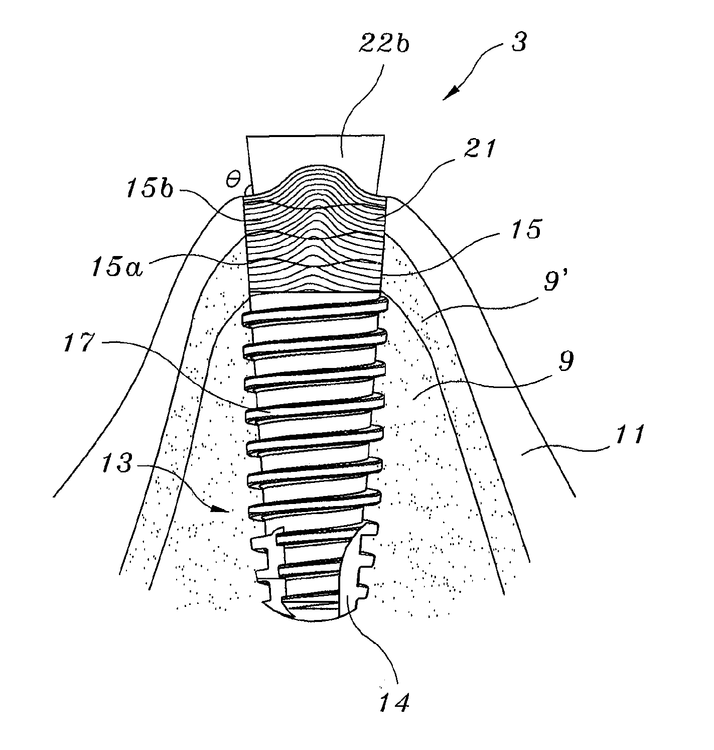 Waved Implant Integrating Soft Tissue Area and Osseous Tissue Area