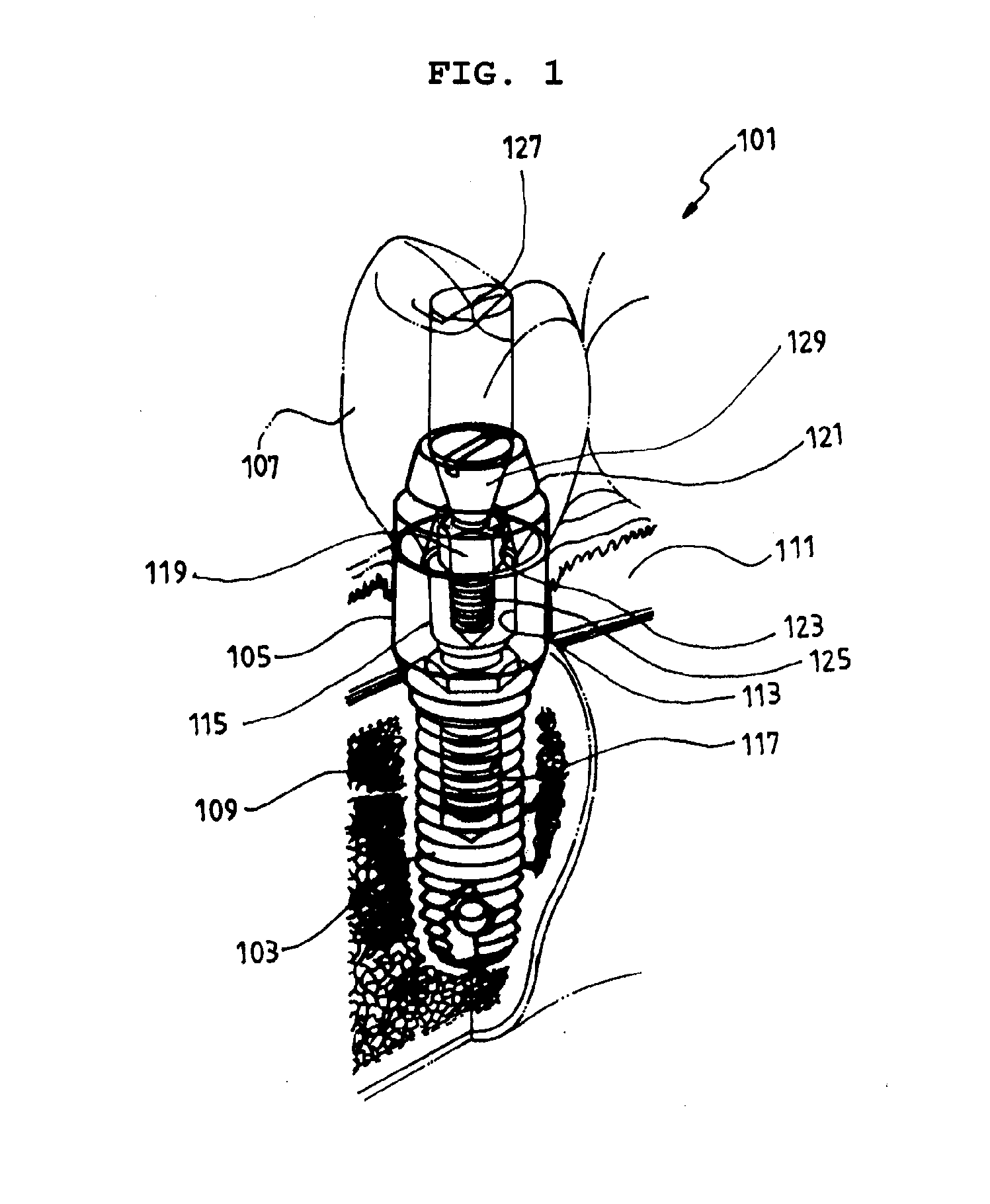 Waved Implant Integrating Soft Tissue Area and Osseous Tissue Area