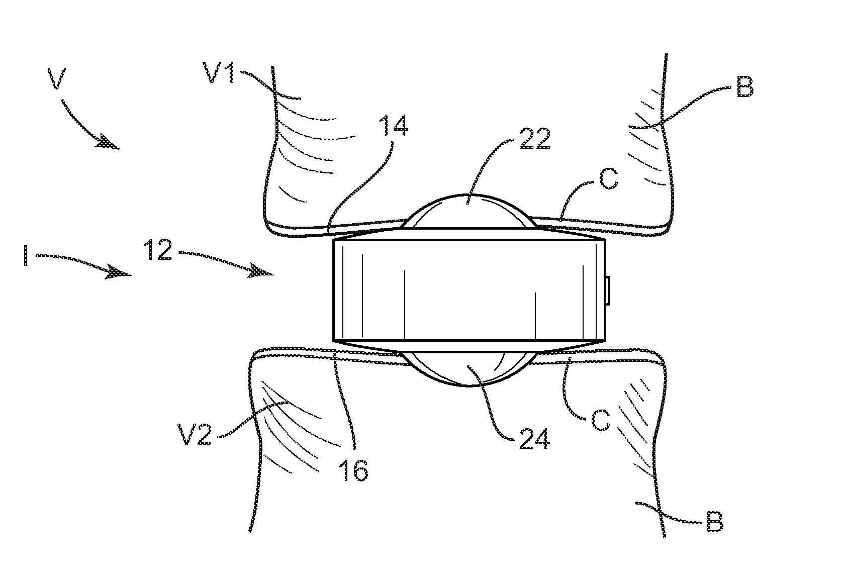 Interbody implant system and methods of use