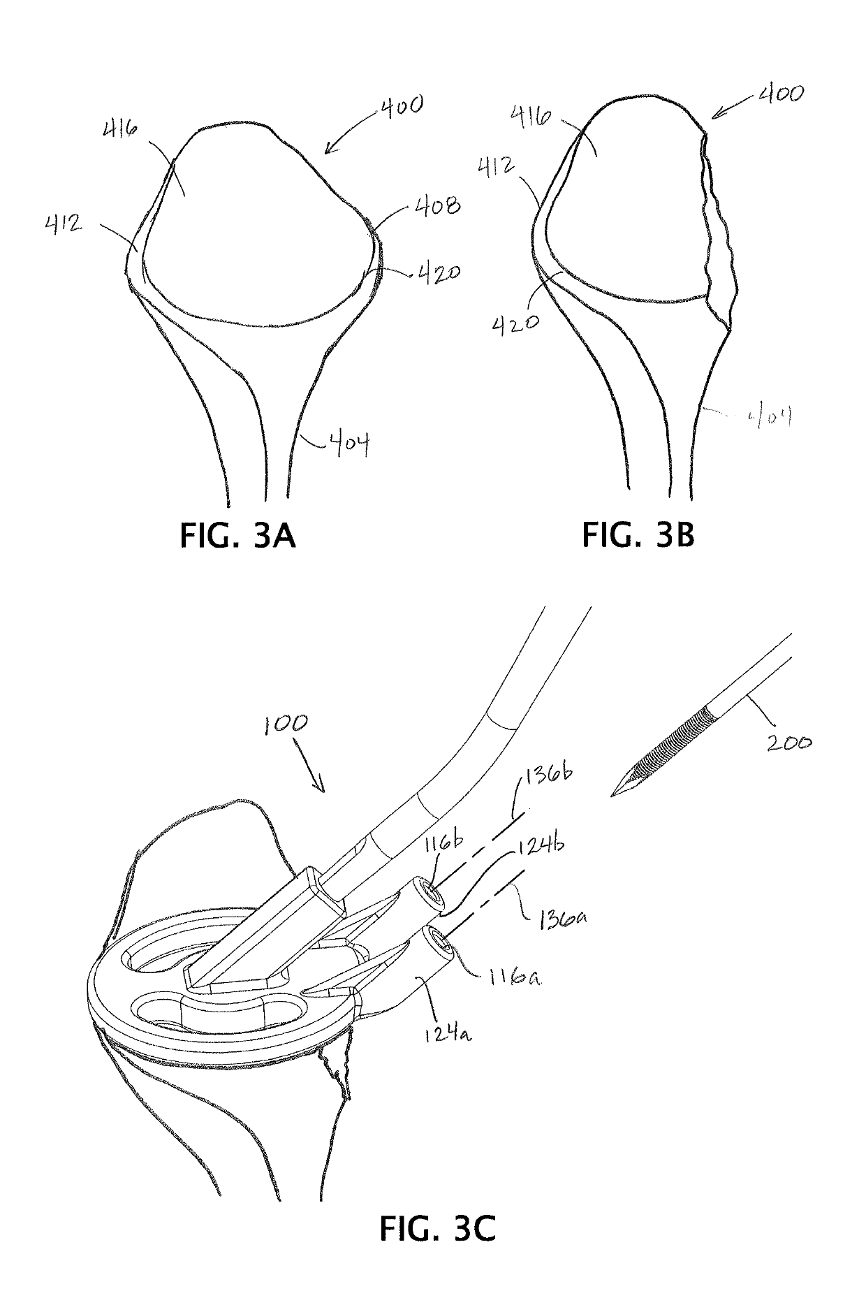 Devices, apparatuses, kits, and methods for repair of articular surface and/or articular rim